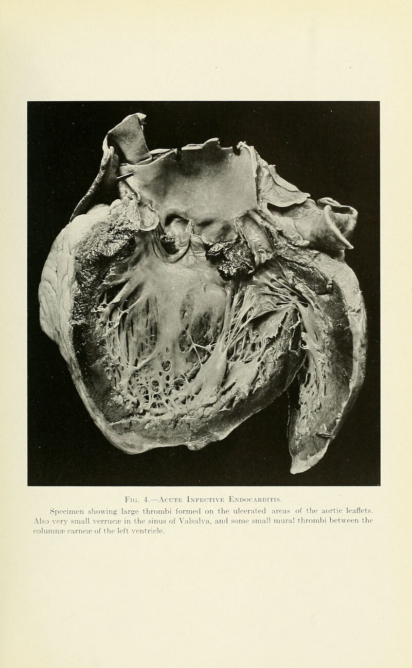 Specimen showing large thrombi formed on the ulcerated areas of the aortic leaflets. .VlsD verj' small verruca in the sinu.s of Valsalva, and some small mural thrombi between the eolumna; oarneic of the left ventricle.
