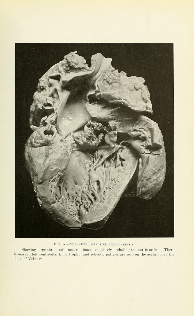 Showing large thrombotic mas.ses almost completely occluding the aortic orifice. There i.s marked left ventricular hypertrophy, and sclerotic patches are seen on the aorta above the sinus of Valsalva.