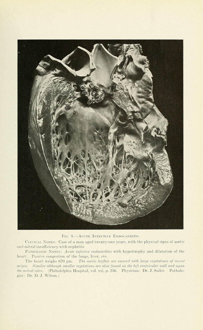 Clixic^i. Notes: Case of a man aged twenty-one years, with the physical signs of aortic and mitral insufficiency with nephritis. Pathologic Notes: Acute infective endocarditis with hypertrophy and dilatation of the heart. Passive oonKcstion of the lungs, hver, etc. The heart weighs G70 gm. The aortic leaflets are covered with large vegetations of recent origin. Similar although smaller vegetations are also found on the left ventricular wall and upon the mitral valve. (Philadelphia Ho.spital, vol. xxi, p. 2.56. Physician: Dr. J. Sailor. Patholo- gist: Dr. D. J. Wilson.)