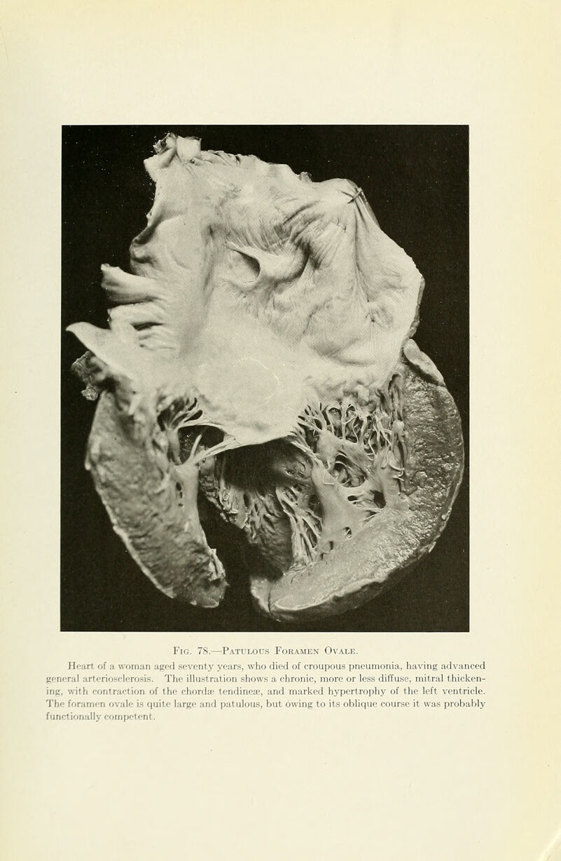Fig. 78.—Patulous Foramen Ovale. Hfart of a woman aged seventy years, who died of croupous pneumonia, liaving advanced general arteriosclerosis. The illustration shows a chronic, more or less diffuse, mitral thicken- ing, with contraction of the ehorchc tendineie, and marked hypertrophy of the left ventricle. The foramen ovale is quite large and patulous, but owing to its oblique course it was probably functionally competent.