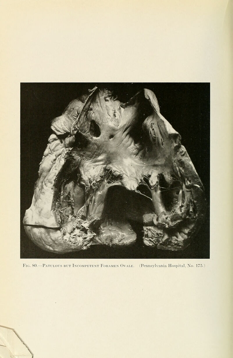 Fig. so.—P.\tulous but Inxompetent For.v.mex 0\ ale. (Pennsylvania Hospital, Xo. 175.