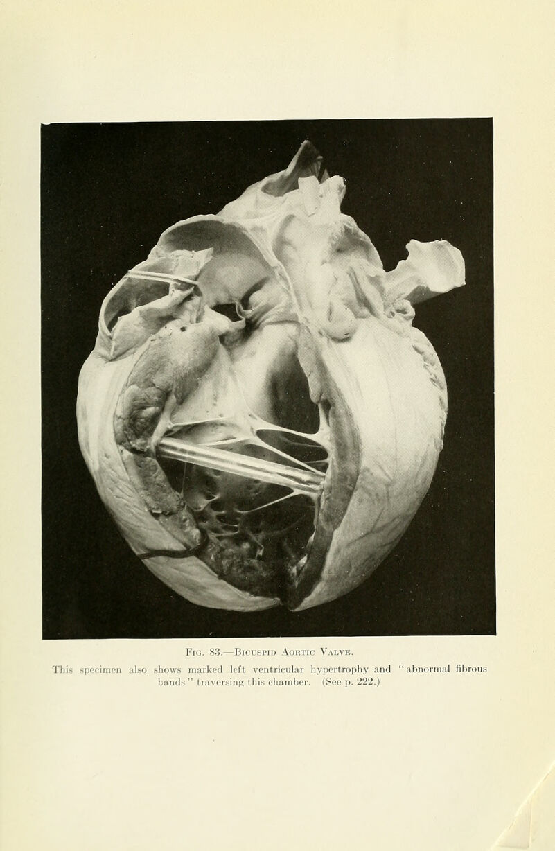 l''ifi. S?>.—Hicrsrin Aortic Valve. This hpocinioM also .shows marked left ventricular hypertrophy and abnoniKd fibrous bands traversing this chamber. (See p. 222.)