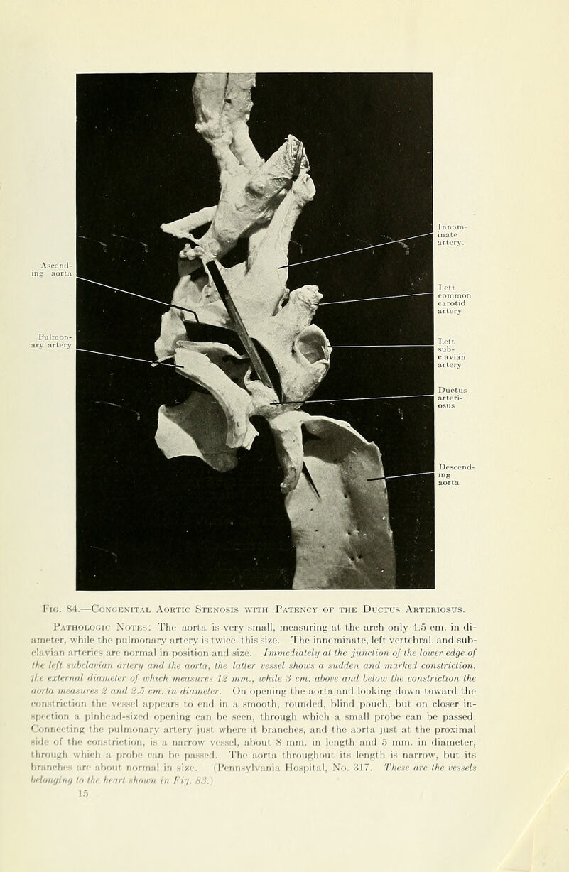 Fic. 84.—Congenital Aortic Stenosis with Patency of the Ductus Arteriosus. Pathologic Notes: The aorta is very small, measuring at the arch only 4.5 cm. in di- ameter, while the pulmonary artery is twice this size. The innominate, left vertebral, and sub- (•l:i\ian urlcrifs are normal in position and size. Immeiialdy at the junction of the lower edge of Ihi: li-fl .inhrliii'ian artery and the aorta, the latter vessel shows a sudden and marked constriction, ll.e external diameter of which measures 12 mm., while S cm,, above and below the constriction the aorta mcanureH 2 and 2.5 cm. in diameter. On opening the aorta and looking down toward the fonstriction the ves-iel appears to end in a smooth, rounded, blind pouch, but on closer in- spection a fjinhoad-sissed opening can bo seen, through which a small probe can be passed. Connecting the pulmonary artery just where it branches, and the aorta just at the proximal side of the constriction, is a narrow ve.s.sel, about S mm. in length and .5 mm. in diameter, through which a [jrobc can be passer!.. The aorta throughout its length is narrow, but its branches are about normal in size. (■Pennsylvania Hospital, Xo. .S17. Thae are the vessels belonging to the heart nhown in Fi;i. HS.) 13