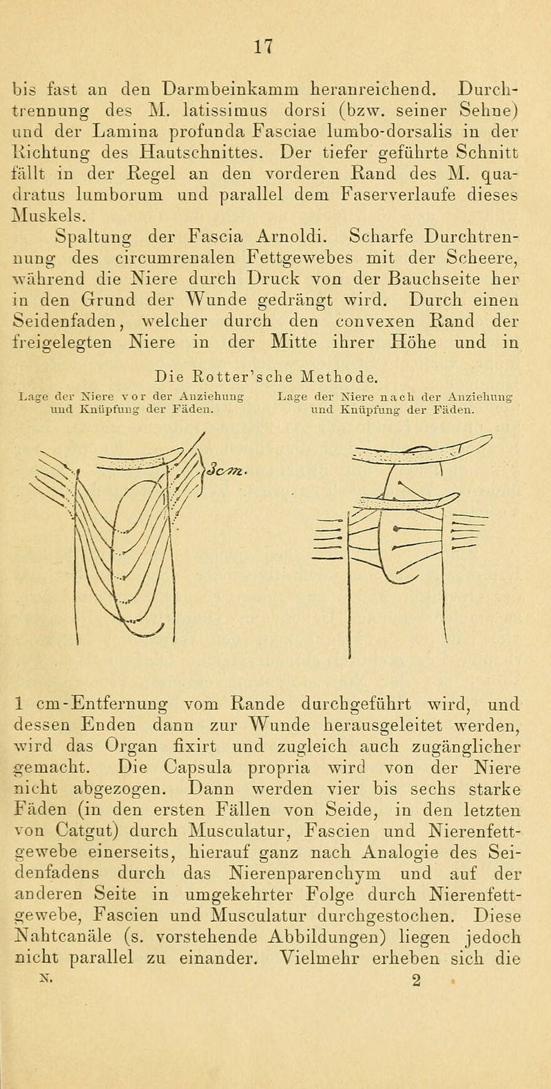 bis fast an den Darmbeinkamm heranreichend. Durch- trennung des M. latissimus dorsi (bzw. seiner Sehne) und der Lamina profunda Fasciae lumbo-dorsalis in der Richtung des Hautschnittes. Der tiefer geführte Schnitt fällt in der Regel an den vorderen Rand des M. qua- dratus lumborum und parallel dem Faserverlaufe dieses Muskels. Spaltung der Fascia Arnoldi. Scharfe Durchtren- uung des circumrenalen Fettgewebes mit der Scheere, während die Niere durch Druck von der Bauchseite her in den Grund der Wunde gedrängt wird. Durch einen Seidenfaden, welcher durch den convexen Rand der freigelegten Niere in der Mitte ihrer Höhe und in Die Rotter'sche Methode. Lage der Niere vor der Anziehiing üud Knüpfung der Fäden. Lage der Xiere nach der Anzielinng und Knüpfting der Fäden. 1 cm-Entfernung vom Rande durchgeführt wird, und dessen Enden dann zur Wunde herausgeleitet werden, wird das Organ fixirt und zugleich auch zugänglicher gemacht. Die Capsula propria wird von der Niere nicht abgezogen. Dann werden vier bis sechs starke Fäden (in den ersten Fällen von Seide, in den letzten von Catgut) durch Musculatur, Fascien und Nierenfett- gewebe einerseits, hierauf ganz nach Analogie des Sei- denfadens durch das Nierenparenchym und auf der anderen Seite in umgekehrter Folge durch Nierenfett- gewebe, Fascien und Musculatur durchgestochen. Diese Nahtcanäle (s. vorstehende Abbildungen) liegen jedoch nicht parallel zu einander. Vielmehr erheben sich die ^'- 2