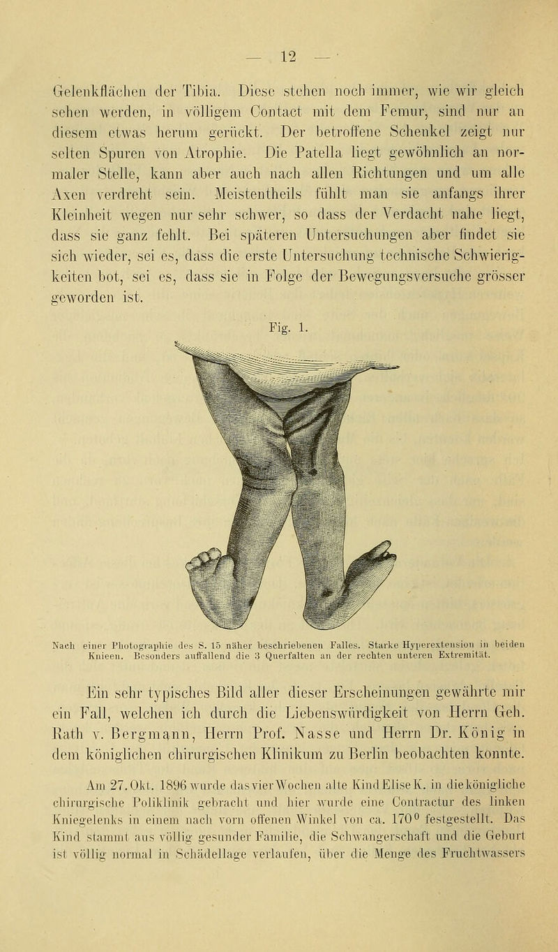 Geleiikflächen der Tibia. Diese stehen noch immer, wie wir gleich sehen werden, in völligem Contact mit dem Femur, sind nur an diesem etwas herum gerückt. Der betroffene Schenkel zeigt nur selten Spuren von Atrophie. Die Patella liegt gewöhnlich an nor- maler Stelle, kann aber auch nach allen Richtungen und um alle Axen verdreht sein. Meistentheils fühlt man sie anfangs ihrer Kleinheit wegen nur sehr schwer, so dass der Verdacht nahe liegt, dass sie ganz fehlt. Bei späteren Untersuchungen aber findet sie sich wieder, sei es, dass die erste Untersuchung technische Schwierig- keiten bot, sei es, dass sie in Folge der Bewegungsversuche grösser geworden ist. Fig. 1 Nach einer Photographie des S. 15 näher heschriebenen Falles. Starke Hyperexteiisioii in beiden Knieen. Besonders auffallend die 3 Querfalten an der rechten unteren Extremität. Ein sehr typisches Bild aller dieser Erscheinungen gewährte mir ein Fall, welchen ich durch die Liebenswürdigkeit von Herrn Geh. Rath V. Bergmann, Herrn Prof. Nasse und Herrn Dr. König in dem königlichen chirurgischen Klinikum zu Berlin beobachten konnte. Am 27. Okt. 1896warde das vier Wochen alte KindEliselv. in dielvönigiiche cliij-urgisclie Polil<linii< gebracht und hier wurde eine Contraotur des linken Kniegelenks in einem nach vorn offenen Winkel von ca. 170^ festgestellt. Das Kind stammt aus völlig gesunder Familie, die SchAvangerschal't und die Geburt ist völlig normal in Schädellage verlaufen, über die Menge des Fruchtwassers