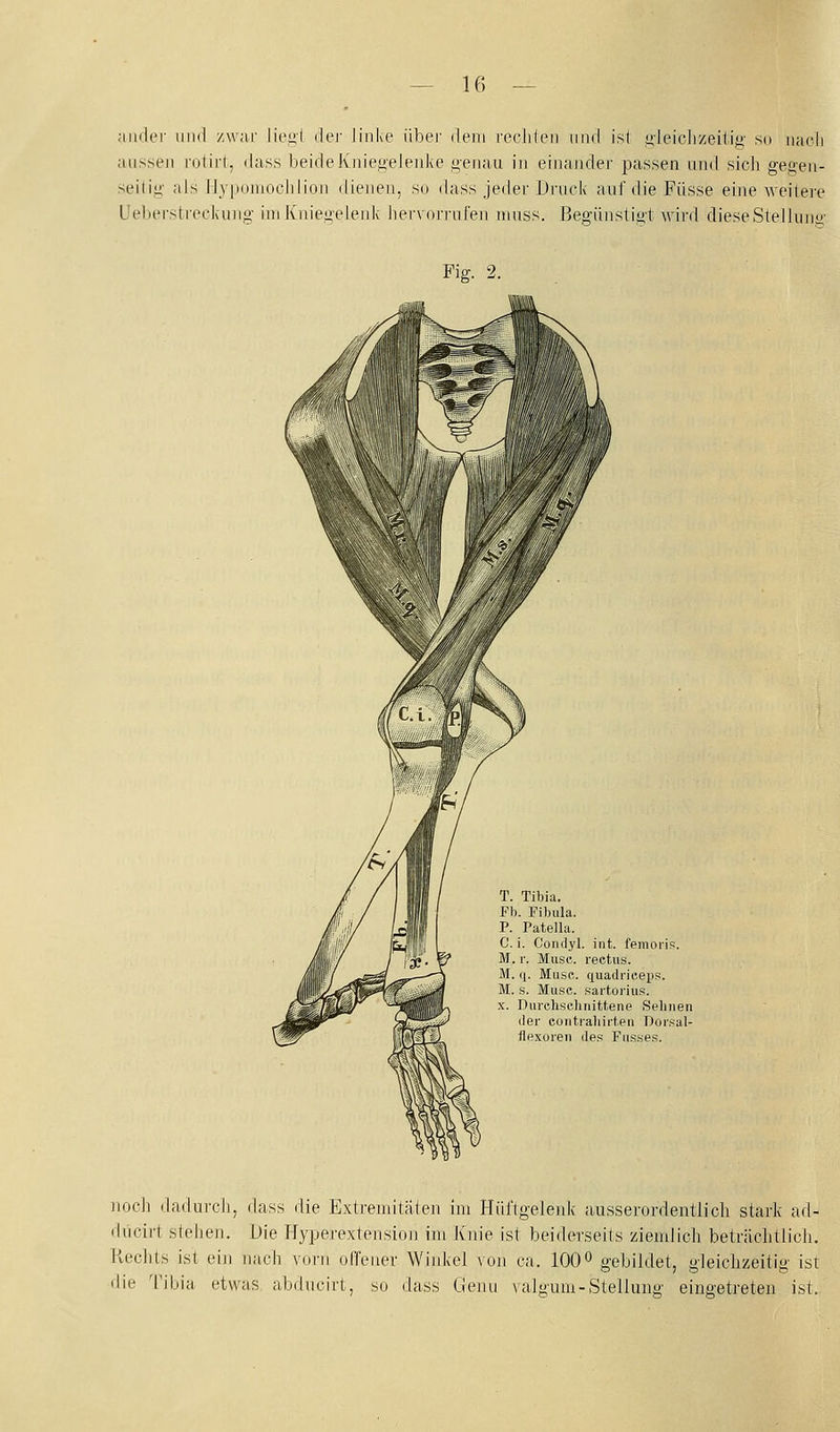 aiidei' und zwar liegt dei- linke übej- dem rechten und ist i^deiclizeitig' so nach aussen rotirt, dass beide Kniegelenke genau in einander passen und sich gegen- seitig als Hypomochlion dienen, so dass jeder Druck auf die Füsse eine Aveilei-e Ueberstreckung im Kniegelenk hervorrufen muss. Begünstigt Avird dieseStellunu' Fig. 2. T. Tibia. Fb. Fibula. P. Patella. C. i. Condyl. int. femoi'is. M, r. Muse, rectus. M. q. Mu.sc. quadrieepp. M. s. Muse, .sai-torius. x. Durcliseliuittene Sebnen er coiitraliii-ten Doisal- flexoreii des Fiisses. noch dadurch, dass die Extrenutaten im Hüftgeleidv ausserordentlich stark ad- dncirt stehen. Die Hyperextension im Knie ist beiderseits ziemlich beträchtlich. Hechts ist ein nach vorn offener Wiitkel von ca. 100^ gebildet, gleichzeitig ist die Tibia etwas abducirt, so dass Geiui \alo'uru-Stelluiiii' eingetreten ist.