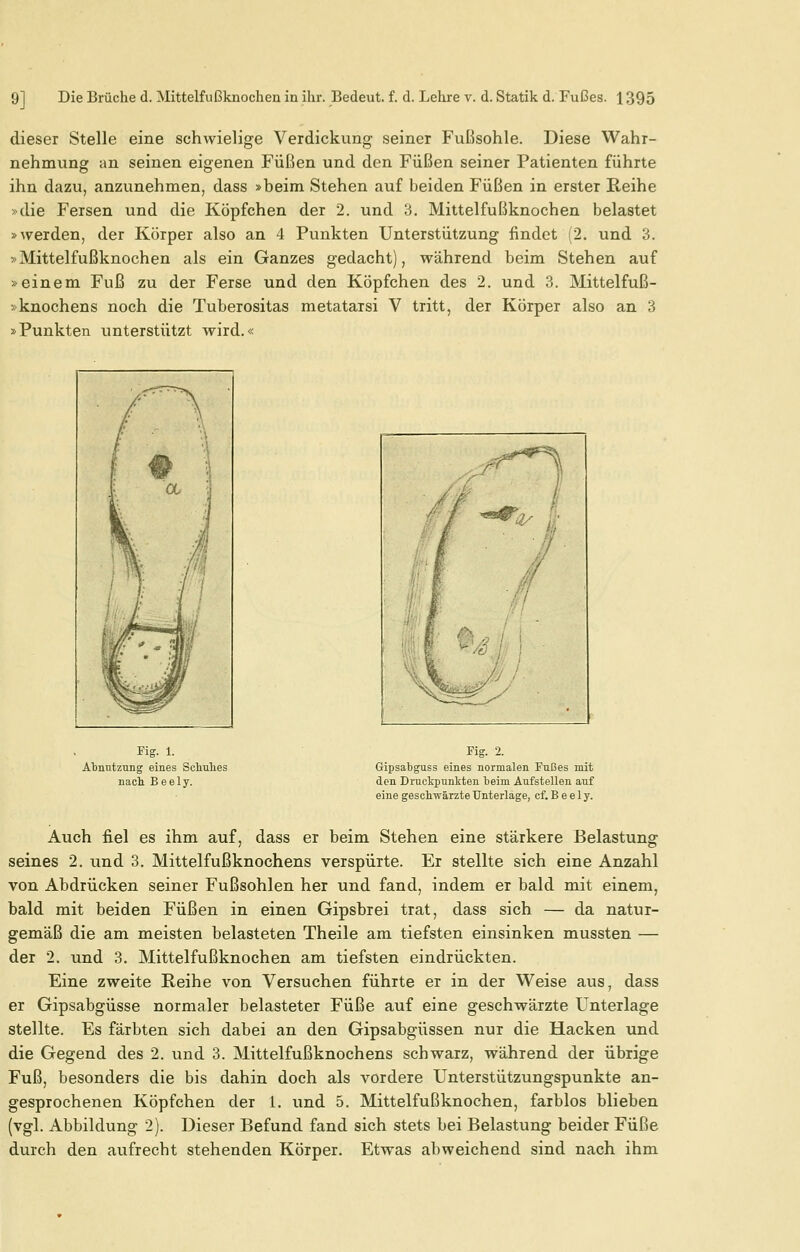 dieser Stelle eine schwielige Verdickung seiner Fußsohle. Diese Wahr- nehmung an seinen eigenen Füßen und den Füßen seiner Patienten führte ihn dazu, anzunehmen, dass »beim Stehen auf beiden Füßen in erster Reihe »die Fersen und die Köpfchen der 2. und 3. Mittelfußknochen belastet »werden, der Körper also an 4 Punkten Unterstützung findet (2. und 3. »Mittelfußknochen als ein Ganzes gedacht), während beim Stehen auf »einem Fuß zu der Ferse und den Köpfchen des 2. und 3. Mittelfuß- »knochens noch die Tuberositas metatarsi V tritt, der Körper also an 3 »Punkten unterstützt wird.« Fig. 1. Abnutzung eines Schuhes nach Beely. Fig. 2. Gipsabguss eines normalen Fußes mit den Druckpunkten beim Aufstellen auf eine geschwärzte Unterlage, cf. B e e 1 y. Auch fiel es ihm auf, dass er beim Stehen eine stärkere Belastung seines 2. und 3. Mittelfußknochens verspürte. Er stellte sich eine Anzahl von Abdrücken seiner Fußsohlen her und fand, indem er bald mit einem, bald mit beiden Füßen in einen Gipsbrei trat, dass sich — da natur- gemäß die am meisten belasteten Theile am tiefsten einsinken mussten — der 2. und 3. Mittelfußknochen am tiefsten eindrückten. Eine zweite Reihe von Versuchen führte er in der Weise aus, dass er Gipsabgüsse normaler belasteter Füße auf eine geschwärzte Unterlage stellte. Es färbten sich dabei an den Gipsabgüssen nur die Hacken und die Gegend des 2. und 3. Mittelfußknochens schwarz, während der übrige Fuß, besonders die bis dahin doch als vordere Unterstützungspunkte an- gesprochenen Köpfchen der 1. und 5. Mittelfußknochen, farblos blieben (vgl. Abbildung 2). Dieser Befund fand sich stets bei Belastung beider Füße durch den aufrecht stehenden Körper. Etwas abweichend sind nach ihm