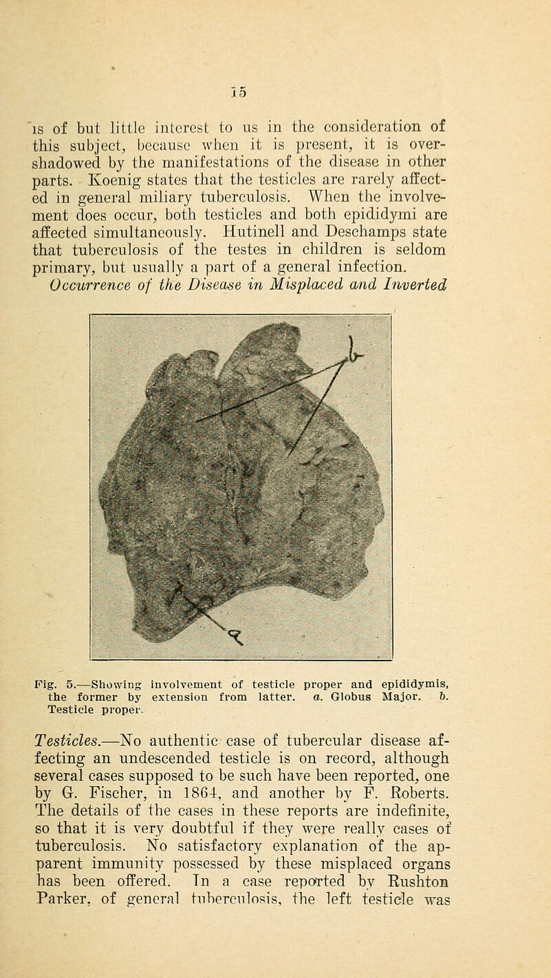 is of but little interest to us in the consideration of this subject, because when it is present, it is over- shadowed by the manifestations of the disease in other parts. Koenig states that the testicles are rarely affect- ed in general miliary tuberculosis. When the involve- ment does occur, both testicles and both epididymi are affected simultaneously. Hutinell and Deschamps state that tuberculosis of the testes in children is seldom primary, but usually a part of a general infection. Occurrence of the Disease in Misplaced and Inverted Fig. 5.—Showing involvement of testicle proper and epididymis, the former by extension from latter. a. Globus Major. 6. Testicle proper. Testicles.—No authentic case of tubercular disease af- fecting an undescended testicle is on record, although several cases supposed to be such have been reported, one by G-. Fischer, in 1864, and another by F. Roberts. The details of the cases in these reports are indefinite, so that it is very doubtful if they were really cases of tuberculosis. No satisfactory explanation of the ap- parent immunity possessed by these misplaced organs has been offered. Tn a case reported by Rushton Parker, of general tuberculosis, the left testicle was