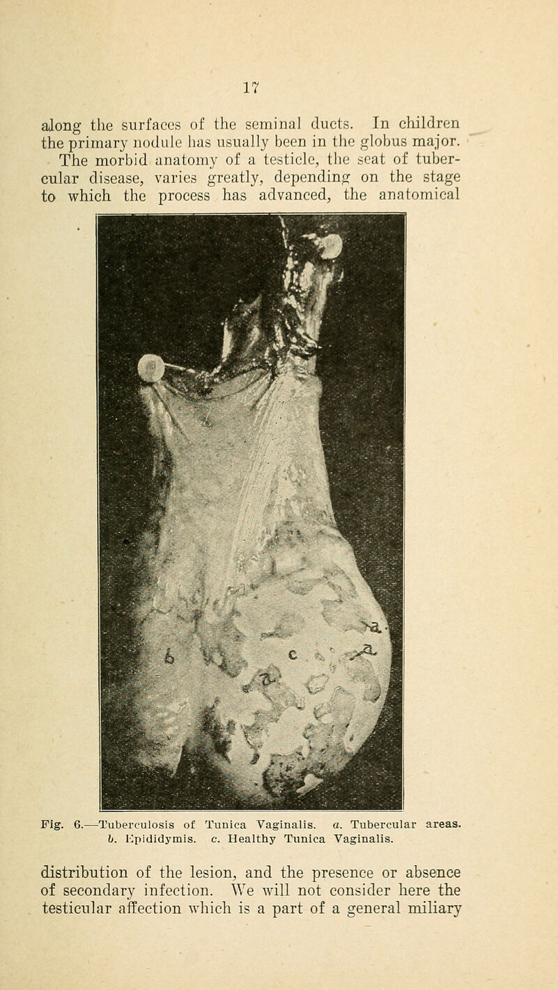 along the surfaces of the seminal ducts. In children the primary nodule has usually been in the globus major. The morbid anatomy of a testicle, the seat of tuber- cular disease, varies greatly, depending on the stage to which the process has advanced, the anatomical Fig. 6.—Tuberculosis of Tunica Vaginalis, a. Tubercular areas. b. Epididymis, c. Healthy Tunica Vaginalis. distribution of the lesion, and the presence or absence of secondary infection. We will not consider here the testicular affection which is a part of a general miliary