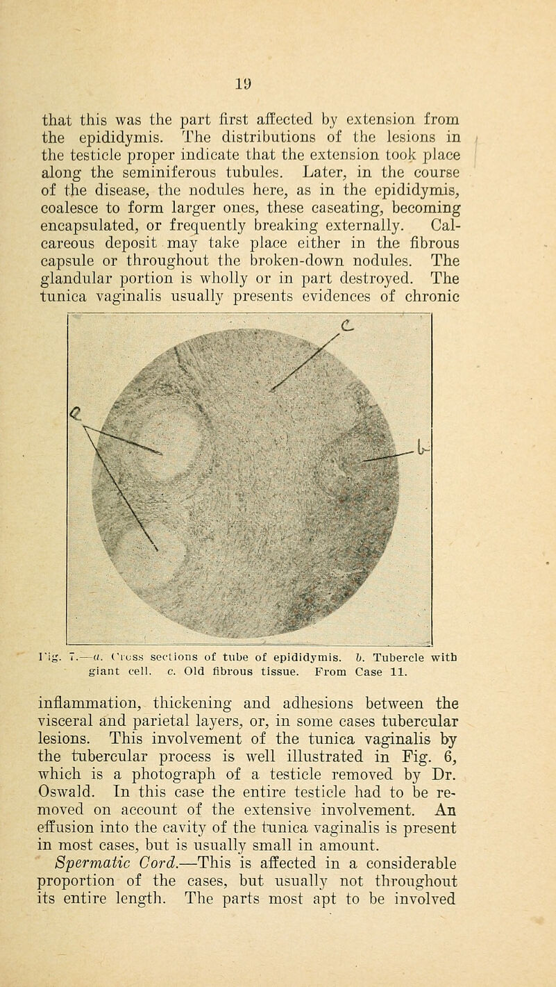 that this was the part first affected by extension from the epididymis. The distributions of the lesions in the testicle proper indicate that the extension took place along the seminiferous tubules. Later, in the course of the disease, the nodules here, as in the epididymis, coalesce to form larger ones, these caseating, becoming encapsulated, or frequently breaking externally. Cal- careous deposit may take place either in the fibrous capsule or throughout the broken-down nodules. The glandular portion is wholly or in part destroyed. The tunica vaginalis usually presents evidences of chronic \ : I'ig. T.—a. Cross sections of tube of epididymis, b. Tubercle witb giant cell. c. Old fibrous tissue. Prom Case 11. inflammation, thickening and adhesions between the visceral and parietal layers, or, in some cases tubercular lesions. This involvement of the tunica vaginalis by the tubercular process is well illustrated in Fig. 6, which is a photograph of a testicle removed by Dr. Oswald. In this case the entire testicle had to be re- moved on account of the extensive involvement. An effusion into the cavity of the tunica vaginalis is present in most cases, but is usually small in amount. Spermatic Cord.—This is affected in a considerable proportion of the cases, but usually not throughout its entire length. The parts most apt to be involved