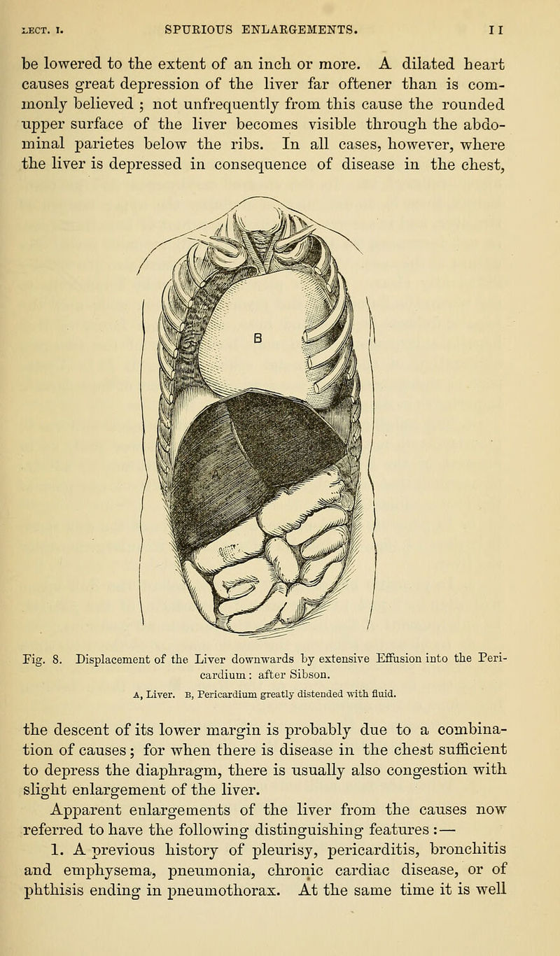 be lowered to the extent of an inch or more. A dilated heart causes great depression of the liver far oftener than is com- monly believed ; not unfrequently from this cause the rounded upper surface of the liver becomes visible through the abdo- minal parietes below the ribs. In all cases, however, where the liver is depressed in consequence of disease in the chest, Fig. 8. Displacement of the Liver downwards by extensive Effasion into the Peri- cardium : after Sibson. A, Liver, b, Pericardium greatly distended ■n-ith fluid. the descent of its lower margin is probably due to a combina- tion of causes ; for when there is disease in the chest sufficient to depress the diaphragm, there is usually also congestion with slight enlargement of the liver. Apparent enlargements of the liver from the causes now referred to have the following distinguishing features : — 1. A previous history of pleurisy, pericarditis, bronchitis and emphysema, pneumonia, chronic cardiac disease, or of phthisis ending in pneumothorax. At the same time it is well