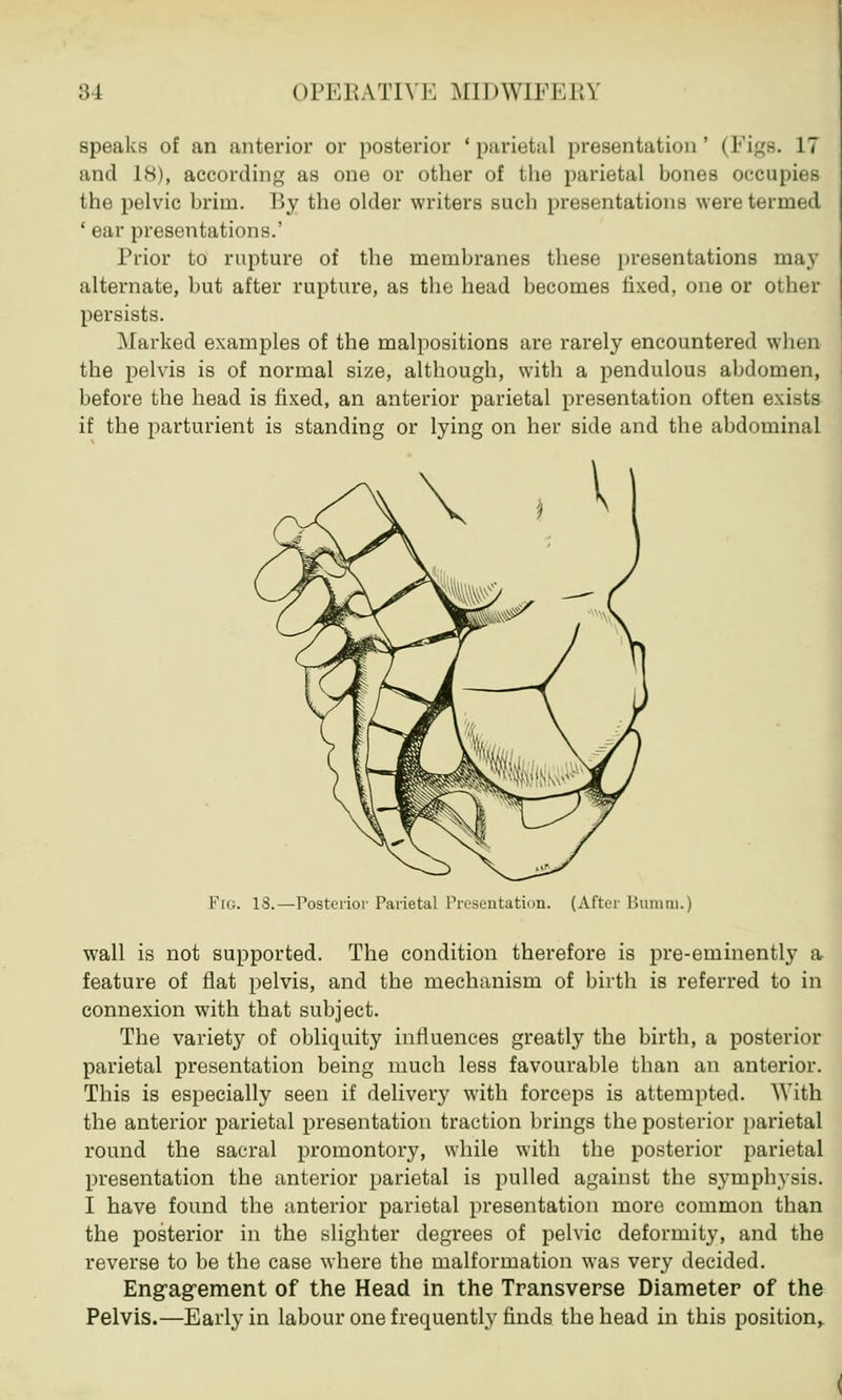 speaks of an anterior or posterior 'parietal presentation' (Figs. 17 and 18), according as one or other of the parietal bones occupies the pelvic brim. \>y the older writers such presentations were termed ' ear presentation-.' Prior to rupture of the membranes these presentations may alternate, but after rupture, as the head becomes fixed, one or other persists. Marked examples of the malpositions are rarely encountered when the pelvis is of normal size, although, with a pendulous abdomen, before the head is fixed, an anterior parietal presentation often exists if the parturient is standing or lying on her side and the abdominal In.. 18.—Posterior Parietal Presentation. (After Bamtn.) wall is not supported. The condition therefore is pre-eminently a feature of flat pelvis, and the mechanism of birth is referred to in connexion with that subject. The variety of obliquity influences greatly the birth, a posterior parietal presentation being much less favourable than an anterior. This is especially seen if delivery with forceps is attempted. With the anterior parietal presentation traction brings the posterior parietal round the sacral promontory, while with the posterior parietal presentation the anterior parietal is pulled against the symphysis. I have found the anterior parietal presentation more common than the posterior in the slighter degrees of pelvic deformity, and the reverse to be the case where the malformation was very decided. Engagement of the Head in the Transverse Diameter of the Pelvis.—Early in labour one frequently finds the head in this position,