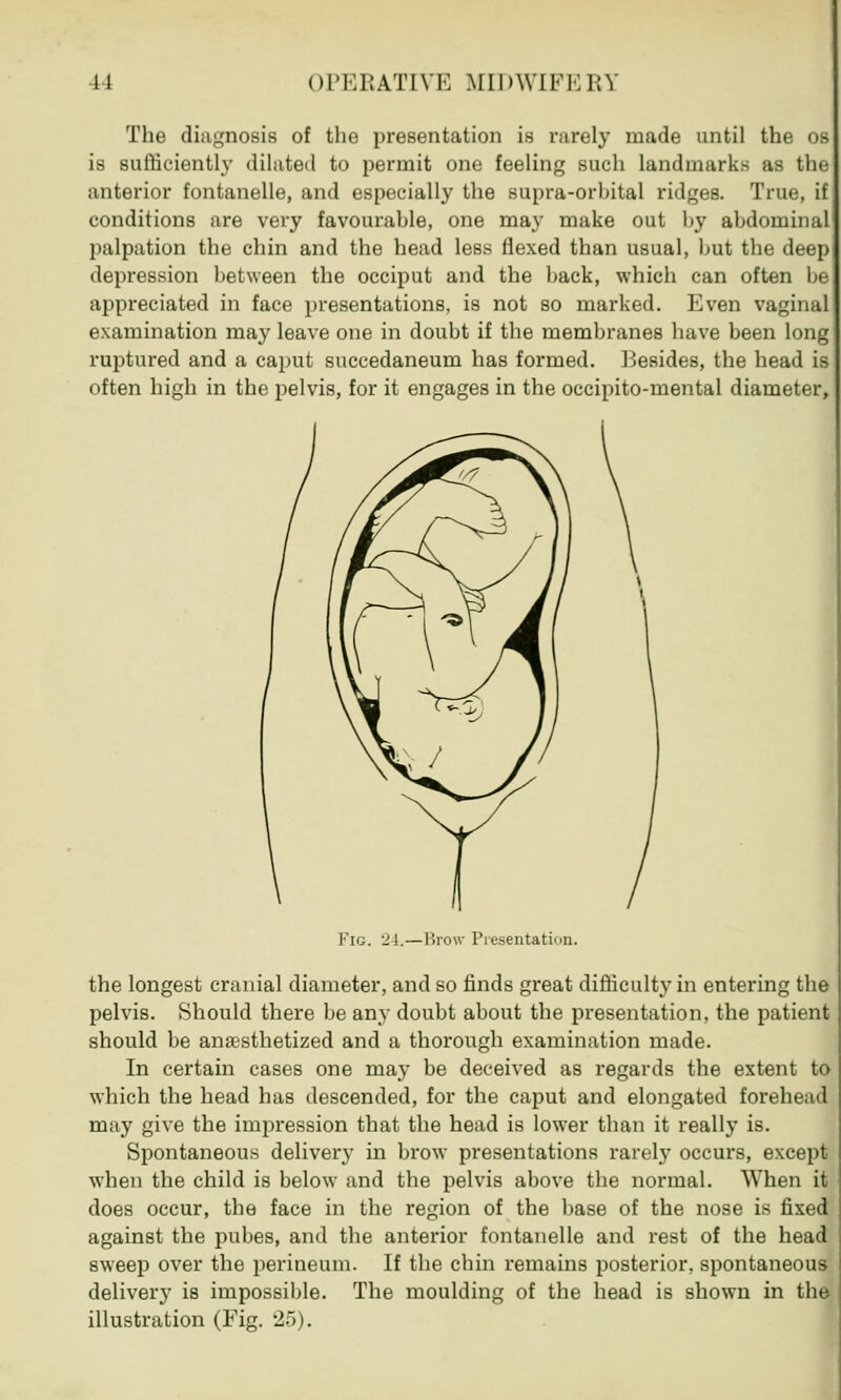 1! OPERATIVE MII>\Vlll.l;\ The diagnosis of the presentation is rarely made until the os is sufficiently dilated to permit one feeling such landmarks as the anterior fontanelle, and especially the supra-orhital ridges. True, if conditions are very favourable, one may make out by abdominal palpation the chin and the head less flexed than usual, but the deep depression between the occiput and the back, which can often be appreciated in face presentations, is not so marked. Even vaginal examination may leave one in doubt if the membranes have been long ruptured and a caput succedaneum has formed. Besides, the head is often high in the pelvis, for it engages in the occipito-mental diameter, FlG. 24.—Brow Presentation. the longest cranial diameter, and so finds great difficulty in entering the pelvis. Should there be any doubt about the presentation, the patient should be anaesthetized and a thorough examination made. In certain cases one may be deceived as regards the extent to which the head has descended, for the caput and elongated forehead may give the impression that the head is lower than it really is. Spontaneous delivery in brow presentations rarely occurs, except when the child is below and the pelvis above the normal. When it does occur, the face in the region of the base of the nose is fixed against the pubes, and the anterior fontanelle and rest of the head sweep over the perineum. If the chin remains posterior, spontaneous deliver}7 is impossible. The moulding of the head is shown in the illustration (Fig. 25).