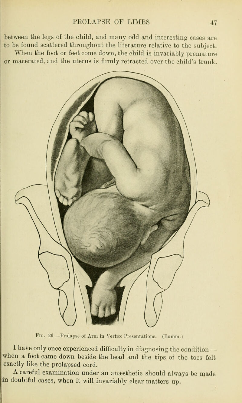 between the legs of the child, and many odd and interesting cases are to be found scattered throughout the literature relative to the subject. When the foot or feet come down, the child is invariably premature or macerated, and the uterus is firmly retracted over the child's trunk. Fig. 26.—Prolapse of Ann in Vertex Presentations. (Bumm.) I have only once experienced difficulty in diagnosing the condition— when a foot came down beside the head and the tips of the toes felt exactly like the prolapsed cord. A careful examination under an anaesthetic should always be made in doubtful cases, when it will invariably clear matters up.