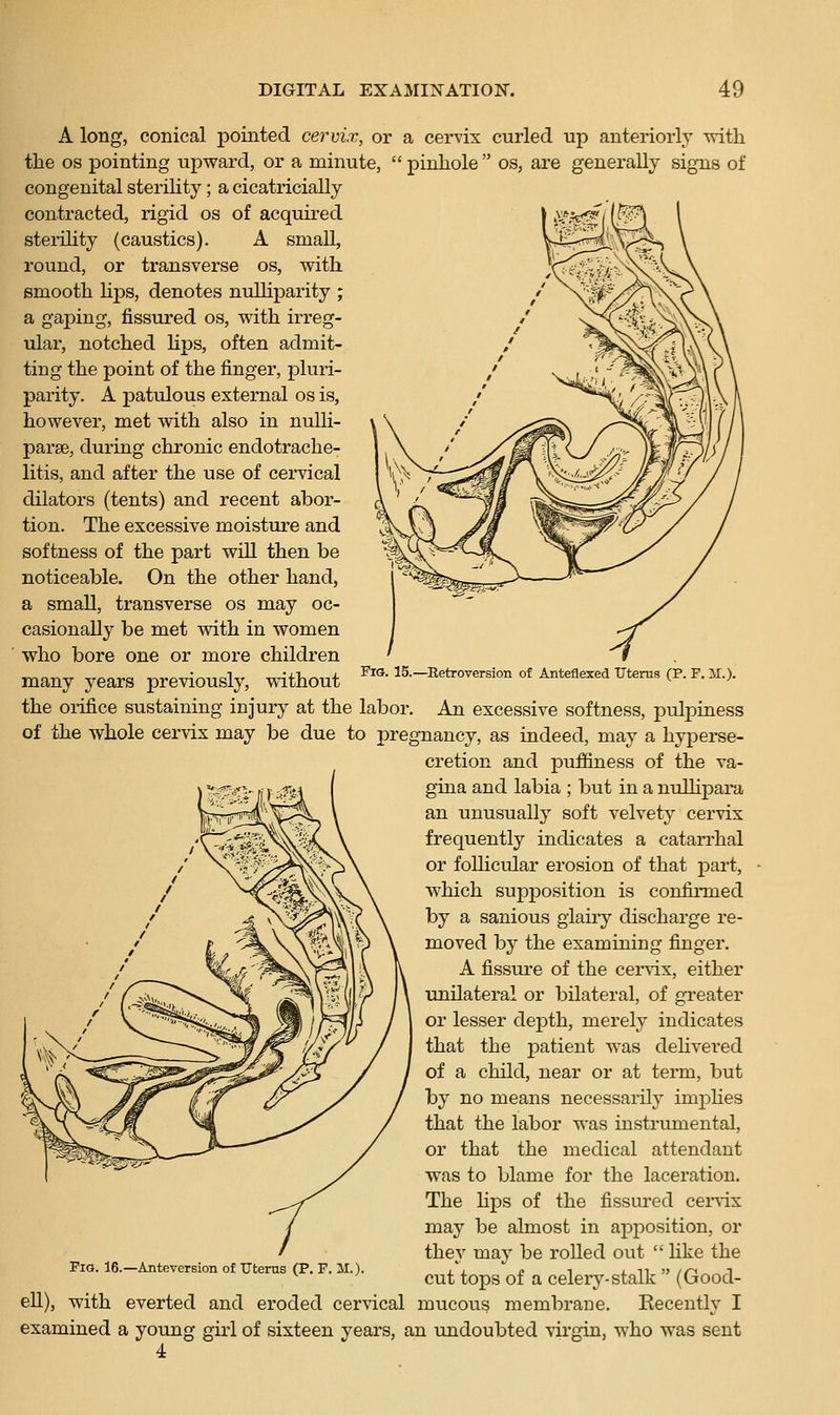 A long, conical pointed cervix, or a cervix curled up anteriorly \vith the OS pointing upward, or a minute,  pinhole  os, are generally signs of congenital sterility; a cicatricially contracted, rigid os of acquii-ed sterHity (caustics). A small, round, or transverse os, with, smooth h]DS, denotes nulliparity ; a gaping, fissured os, with irreg- ular, notched hps, often admit- ting the point of the finger, pluri- parity. A patulous external os is, however, met with also in nulli- parae, during chronic endotrache- litis, and after the use of cervical dilators (tents) and recent abor- tion. The excessive moisture and softness of the part will then be noticeable. On the other hand, a small, transverse os may oc- casionally be met with in women who bore one or more children many years previously, mthout '''°- IS-Retroversion of Anteflexed ITterus (P. F. U.). the orifice sustaining injury at the labor. An excessive softness, pulpiness of the whole cervix may be due to pregnancy, as indeed, may a hyperse- cretion and puffiness of the va- gina and labia ; but in a nullipara an unusually soft velvety cervix frequently indicates a catarrhal or follicular erosion of that part, which supposition is confirmed by a sanious glaiiy discharge re- moved by the examining finger. A fissure of the cervix, either unilateral or bilateral, of greater or lesser depth, merely indicates that the patient was delivered of a child, near or at term, but by no means necessarily implies that the labor was instrumental, or that the medical attendant was to blame for the laceration. The Hps of the fissui-ed cei-vix may be almost in apposition, or thev may be rolled out  like the Fio. 16.-Anteversion of Uterns (P. F. M.). ^^{^^^^ ^^ ^ Celery-stalk  (Good- ell), with everted and eroded cervical mucous membrane. Recently I examined a young girl of sixteen years, an undoubted virgin, who was sent 4