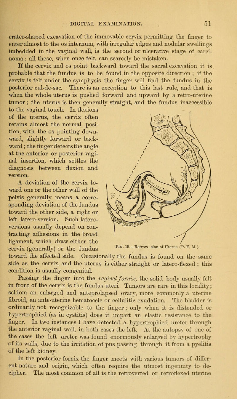 crater-shaped excavation of the immovable cervix permitting the finger to enter almost to the os internum, with irregular edges and nodular swelUngs imbedded in the vaginal wall, is the second or ulcerative stage of carci- noma : all these, when once felt, can scarcely be mistaken. If the cervix and os point backward toward the sacral excavation it is probable that the fundus is to be found in the opposite direction ; if the cervix is felt under the symphysis the finger will find the fundus in the posterior cul-de-sac. There is an exception to this last rule, and that is when the whole uterus is pushed forward and upward by a retro-uterine tumor; the uterus is then generally straight, and the fundus inaccessible to the vaginal touch. In flexions of the uterus, the cervix often retains almost the normal posi- tion, with the OS pointing down- ward, slightly forward or back- ward ; the finger detects the angle at the anterior or posterior vagi- nal insertion, which settles the diagnosis between flexion and version, A deviation of the cervix to- ward one or the other wall of the pelvis generally means a corre- sponding deviation of the fundus toward the other side, a right or left latero-version. Such latero- versions usually depend on con- tracting adhesions in the broad Hgament, which diaw either the cervix (generaUy) or the fundus ^'^- ^^--i^^t^^^' ^^°^ of ^te™« (p- ^- ^■^■ toward the affected side. Occasionally the fundus is found on the same side as the cervix, and the uterus is either straight or latero-flexed ; this condition is usually congenital. Passing the finger into the vaginal fornix, the solid body usually felt in front of the cervix is the fundus uteri. Tumors are rare in this locality; seldom an enlarged and anteprolapsed ovary, more commonly a uterine fibroid, an ante-uterine hematocele or cellulitic exudation. The bladder is ordinarily not recognizable to the finger; only when it is distended or hypertrophied (as in cystitis) does it impart an elastic resistance to the finger. In two instances I have detected a hypertrophied ureter through the anterior vaginal wall, in both cases the left. At the autopsy of one of the cases the left ureter was found enormously enlarged by hypertrophy of its walls, due to the irritation of pus passing through it from a pyelitis of the left kidney. In the posterior fornix the finger meets with various tumors of difier- ent nature and origin, which often require the utmost ingenuity to de- cipher. The most common of all is the retroverted or retroflexed uterine