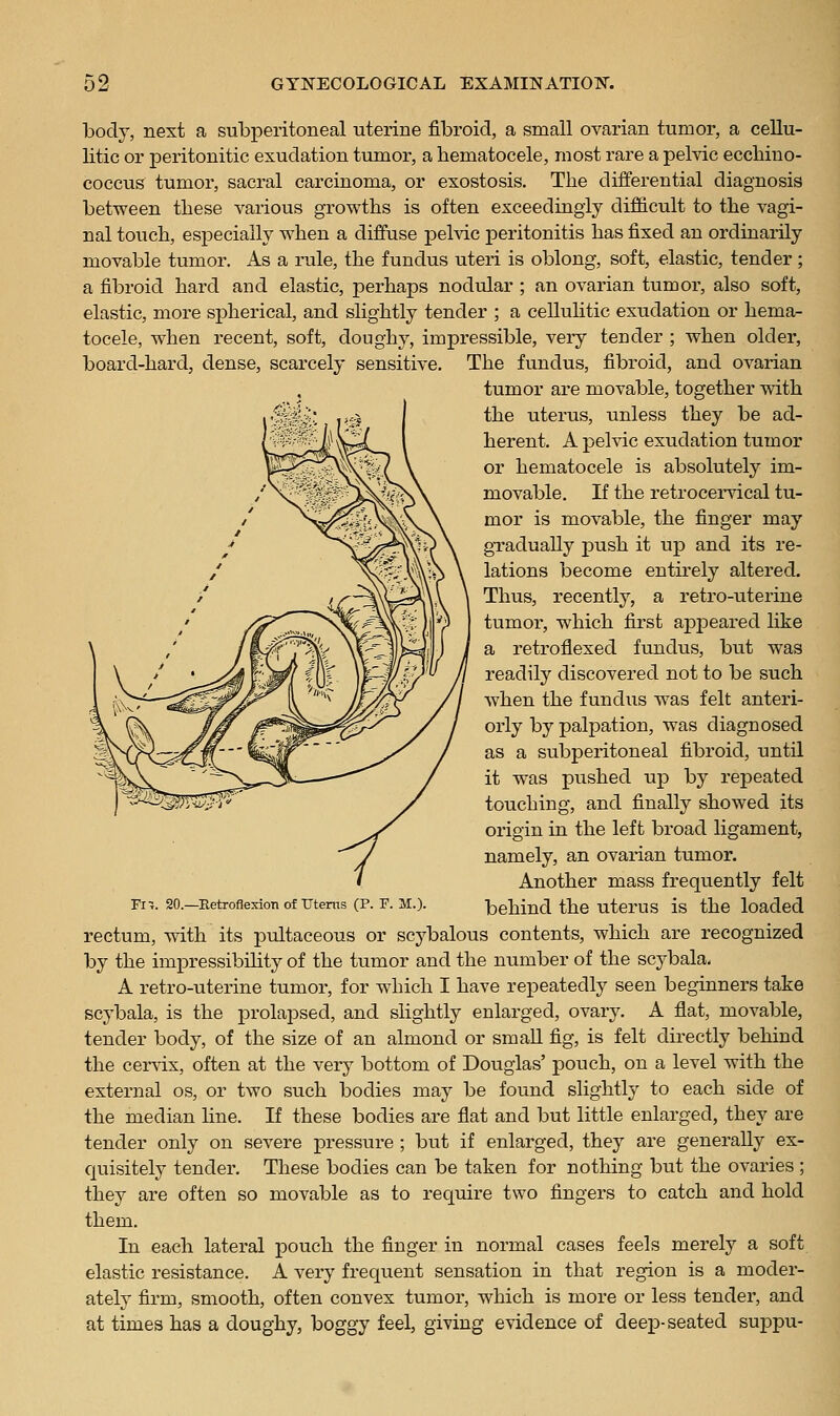 body, next a subperitoneal uterine fibroid, a small ovarian tumor, a cellu- litic or peritonitic exudation tumor, a hematocele, most rare a pelvic eccbino- coccus tumor, sacral carcinoma, or exostosis. The differential diagnosis between these various growths is often exceedingly difiicult to the vagi- nal touch, especially when a diffuse pelvic peritonitis has fixed an ordinarily movable tumor. As a rule, the fundus uteri is oblong, soft, elastic, tender; a fibroid hard and elastic, perhaps nodular ; an ovarian tumor, also soft, elastic, more sj)herical, and slightly tender ; a celluHtic exudation or hema- tocele, when recent, soft, doughy, impressible, veiy tender ; when older, board-hardj dense, scarcely sensitive. The fundus, fibroid, and ovarian tumor are movable, together with the uterus, unless they be ad- herent. A pelvic exudation tumor or hematocele is absolutely im- movable. If the retrocervical tu- mor is movable, the finger may gradually push it up and its re- lations become entirely altered. Thus, recently, a retro-uterine tumor, which first apjDeared like a retroflexed fundus, but was readily discovered not to be such when the fundus was felt anteri- orly by palpation, was diagnosed as a subperitoneal fibroid, until it was pushed up by repeated touching, and finally showed its origin in the left broad ligament, namely, an ovarian tumor. Another mass frequently felt m. 20.-Eetroflexion oftJteros (P. F. M.). behind the utcrus is the loaded rectum, with its pultaceous or scybalous contents, which are recognized by the impressibihty of the tumor and the number of the scybala. A retro-uterine tumor, for which I have repeatedly seen beginners take scybala, is the prolapsed, and slightly enlarged, ovary. A flat, movable, tender body, of the size of an almond or small fig, is felt directly behind the cervix, often at the very bottom of Douglas' pouch, on a level with the external os, or two such bodies may be found slightly to each side of the median hue. If these bodies are flat and but little enlarged, they are tender only on severe pressui-e ; but if enlarged, they are generally ex- quisitely tender. These bodies can be taken for nothing but the ovaries ; they are often so movable as to require two fingers to catch and hold them. In each lateral pouch the finger in normal cases feels merely a soft elastic resistance. A very frequent sensation in that region is a moder- ately firm, smooth, often convex tumor, which is more or less tender, and at times has a doughy, boggy feel, giving evidence of deep-seated suppu-