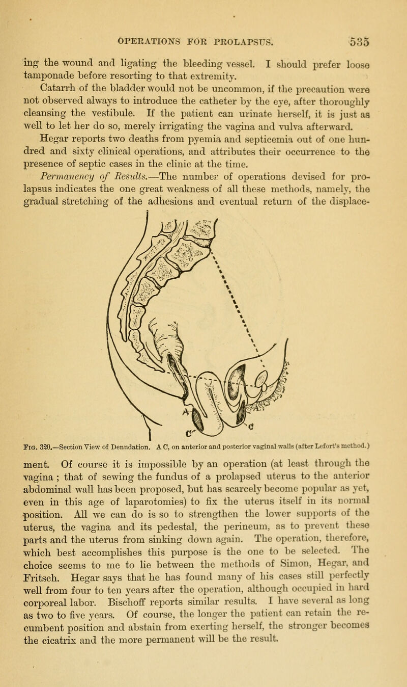 ing the wound cand ligating the loleeding vessel. I should prefer loose tamponade before resorting to that extremity. Catan-h of the bladder would not be uncommon, if the precaution were not observed always to introduce the catheter by the eye, after thoroughly cleansing the vestibule. If the patient can urinate herself, it is just aa well to let her do so, merely irrigating the vagina and vulva afterward. Hegar reports two deaths from pyemia and septicemia out of one hun- dred and sixty clinical operations, and attributes their occiu'rence to the presence of septic cases in the clinic at the time. Permanency of BesuUs.—The numbe;* of operations devised for pro- lapsus indicates the one great weakness of all these methods, namely, the gradual stretching of the adhesions and eventual retui-n of the displace- FiG, 320.—Section View of Denndation. A C, on anterior and posterior vaginal walls (after Lef orfs method.) ment. Of covirse it is impossible by an operation (at least through the vagina ; that of sewing the fundus of a prolapsed uterus to the anterior abdominal wall has been proposed, but has scarcely become popular as yet, even in this age of laparotomies) to fix the utenis itself in its normal •position. All we can do is so to sti-engthen the lower supports of the uterus, the vagina and its pedestal, the perineum, as to prevent these parts and the uterus from sinking down again. The operation, tlierefore, which best accomplishes this purpose is the one to be selected. The choice seems to me to lie between the methods of Simon, Hegar, and Fritsch. Hegar says that he has found many of his cases still perfectly well from four to ten years after the operation, although occupied in hard corporeal labor. Bischofif reports similar results. I have several as long as two to five years. Of course, the longer the patient can retain the re- cumbent position and abstain from exerting herself, the sti'ouger becomes the cicatrix and the more permanent will be the result.