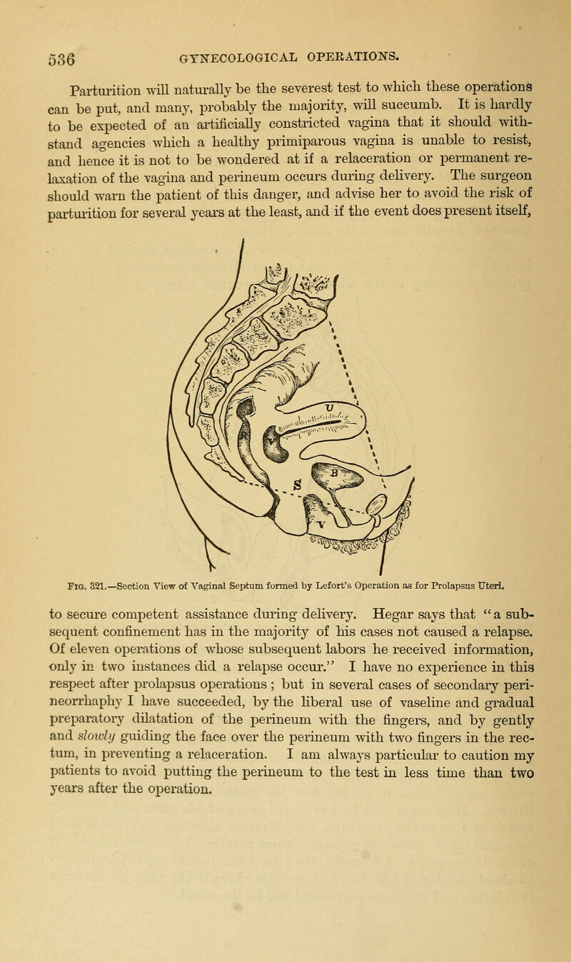 Parturition will naturally be the severest test to which these operations can be put, and many, probably the majority, will succumb. It is hardly to be expected of an ai'tificially constricted vagina that it should with- stand agencies which a healthy primiparous vagina is unable to resist, and hence it is not to be wondered at if a relaceration or permanent re- laxation of the vagina and perineum occurs durmg dehvery. The surgeon should warn the patient of this danger, and advise her to avoid the risk of parturition for several yeai'S at the least, and if the event does present itself. Fig. 321.—Section View of Vaginal Septum formed by Lefort's Operation as for Prolapsus Uteri. to secure competent assistance during delivery. Hegar says that  a sub- sequent confinement has in the majority of his cases not caused a relapse. Of eleven operations of whose subsequent labors he received information, only in two instances did a relapse occur. I have no experience in this respect after prolapsus operations ; but in several cases of secondary peri- neorrhaphy I have succeeded, by the liberal use of vaseline and gradual preparatory dilatation of the perineum with the fingers, and by gently and slowly guiding the face over the perineum with two fingers in the rec- tum, in preventing a relaceration. I am always particular to caution my patients to avoid putting the perineum to the test in less time than two years after the operation.