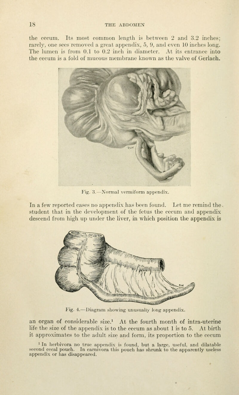 the cecum. Its most common length is between 2 and 3.2 inches; rarely, one sees removed a great appendix, 5, 9, and even 10 inches long. The lumen is from 0.1 to 0.2 inch in diameter. At its entrance into the cecum is a fold of mucous membrane known as the valve of Gerlach. Fig. 3.—Normal vermiform appendix. In a few reported cases no appendix has been found. Let me remind the. student that in the development of the fetus the cecum and appendix descend from high up under the liver, in which position the appendix is Fig. 4.—Diagram showing unusually long appendix. an organ of considerable size.* At the fourth month of intra-uterine life the size of the appendix is to the cecum as about 1 is to 5. At birth it approximates to the adult size and foi-m, its proportion to the cecum 1 In herbivora no true appendix is found, but a large, useful, and dilatable second cecal pouch. In carnivora this pouch has shrunk to the apparently useless appendix or has disappeared.