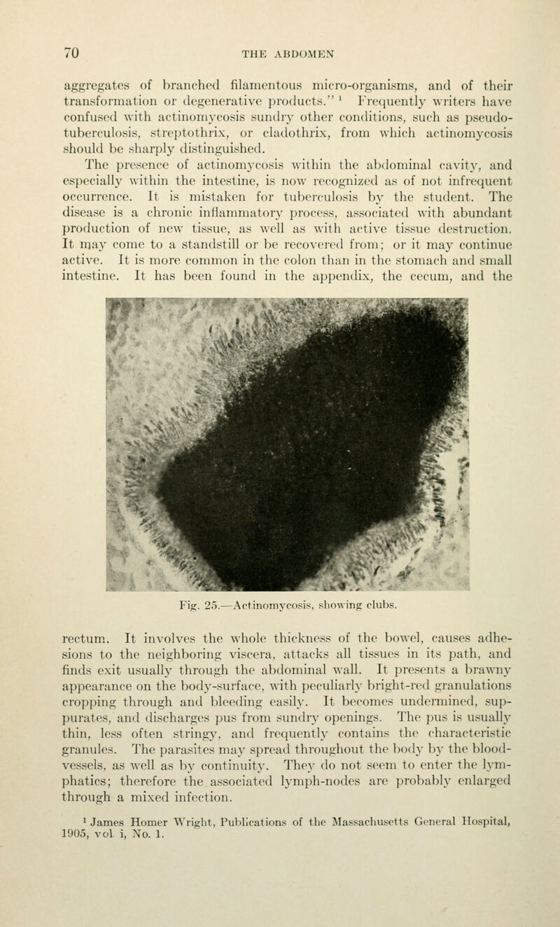 aggregates of branched filamentous micro-organisms, and of their transformation or degenerative products. ' Frequently writers have confused with actinomycosis sunth}- other conditions, such as pseudo- tuberculosis, streptothrix, or cladothrix, from which actinomycosis should be sharplj^ distinguished. The presence of actinomycosis within the abdominal cavity, and especially within the intestine, is now recognized as of not infrequent occurrence. It is mistaken for tuberculosis by the student. The disease is a chronic inflammatory jjrocess, associated with abundant production of new tissue, as well as with active tissue destruction. It njay come to a standstill or be recovered from; or it may continue active. It is more common in the colon than in the stomach and small intestine. It has been found in the appendix, the cecum, and the Fig. 25.—Actinomycosis, showing clubs. rectum.. It involves the whole thickness of the bowel, causes adhe- sions to the neighboring viscera, attacks all tissues in its path, and finds exit usually through the abdominal wall. It presents a brawny appearance on the body-surface, with peculiarly bright-red granulations cropping through and bleeding easily. It becomes undermined, sup- purates, and discharges pus from sundry openings. The pus is usually thin, less often stringy, and frequently contains the characteristic granules. The parasites ma}' spread throughout the body b}' the blood- vessels, as well as by continuity. They do not seem to enter the lym- phatics; therefore the associated lymph-nodes are probably enlarged through a mixed infection. ^ James Homer Wright, Puljlications of tlie Massachusetts General Hospital, 1905, vol. i, No. 1.