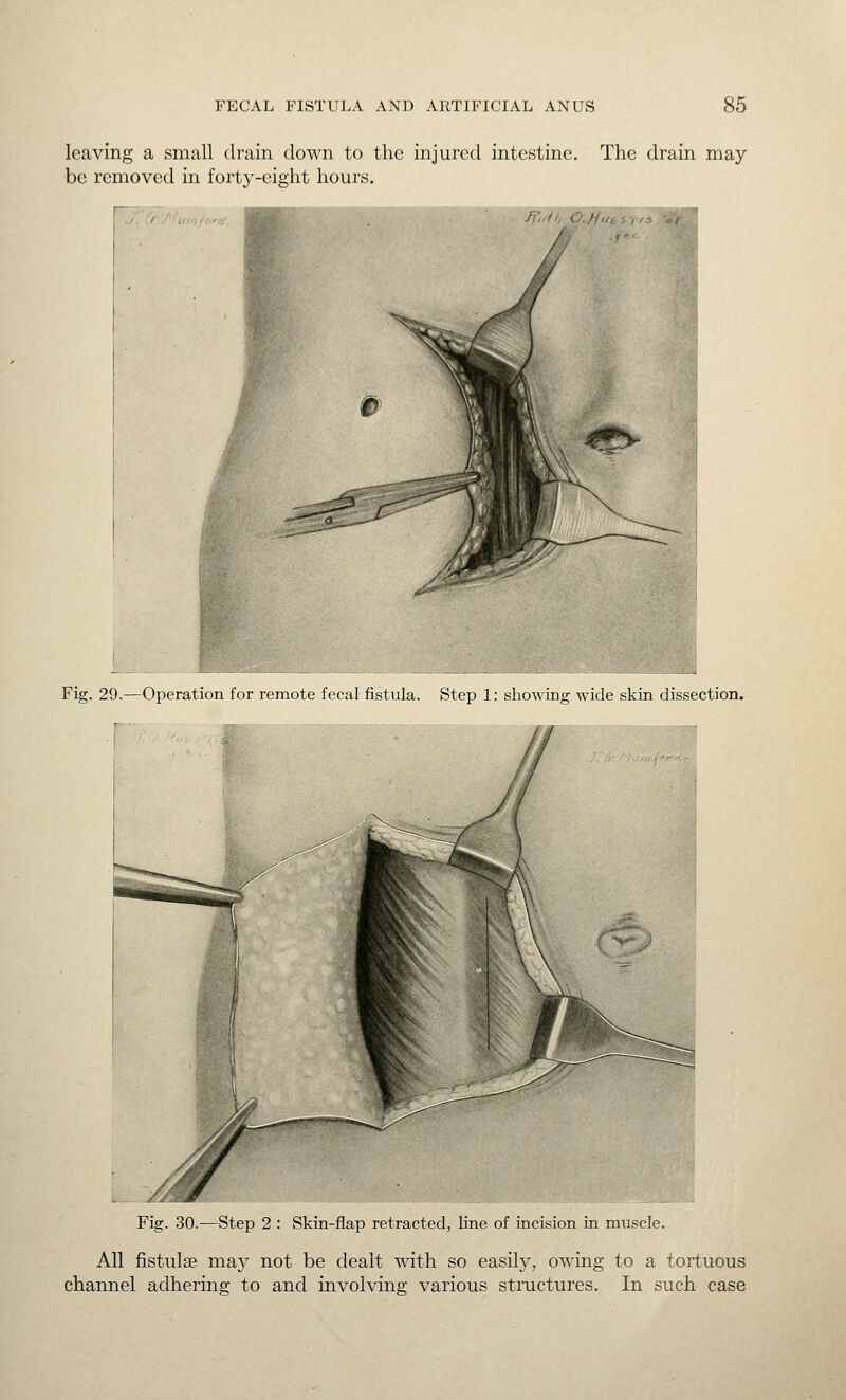 leaving a small drain down to the injured intestine. The drain may be removed in forty-eight hours. Fig. 29.—Operation for remote fecal fistula. Step 1: showing wide skin dissection. r Fig. 30.—Step 2 : Skin-flap retracted, line of incision in muscle. All fistulse may not be dealt with so easily, owing to a tortuous channel adhering to and involving various structures. In such case