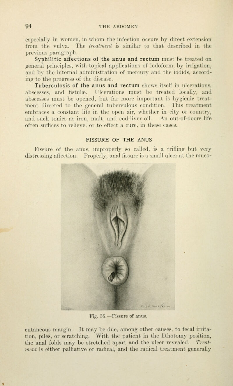 especiall}' in women, in whom the infection occurs by direct extension from the vulva. The tn-aiment is similar to that described in the previous paragraph. Syphilitic affections of the anus and rectum must be treated on general principles, with to})ical applications of iodoform, by irrigation, and by the internal administration of mercury and the iodids, accord- ing to the progress of the disease. Tuberculosis of the anus and rectum shows itself in ulcerations, abscesses, and fistula^. Ulcerations must be treated locally, and abscesses must be opened, but far more important is hygienic treat- ment directed to the general tuberculous condition. This treatment embraces a constant life in the open air, whether in city or country, and such tonics as iron, malt, and cod-liver oil. An out-of-doors life often suffices to relieve, or to effect a cure, in these cases. FISSURE OF THE ANUS Fissure of the anus, improperly so called, is a trifling but very distressing affection. Properly, anal fissure is a small ulcer at the muco- Fig. 35.—Fissure of anus. cutaneous margin. It may be due, among other causes, to fecal irrita- tion, piles, or scratching. With the patient in the lithotomy position, the anal folds may be stretched apart and the ulcer revealed. Treat- ment is either palliative or radical, and the radical treatment generally