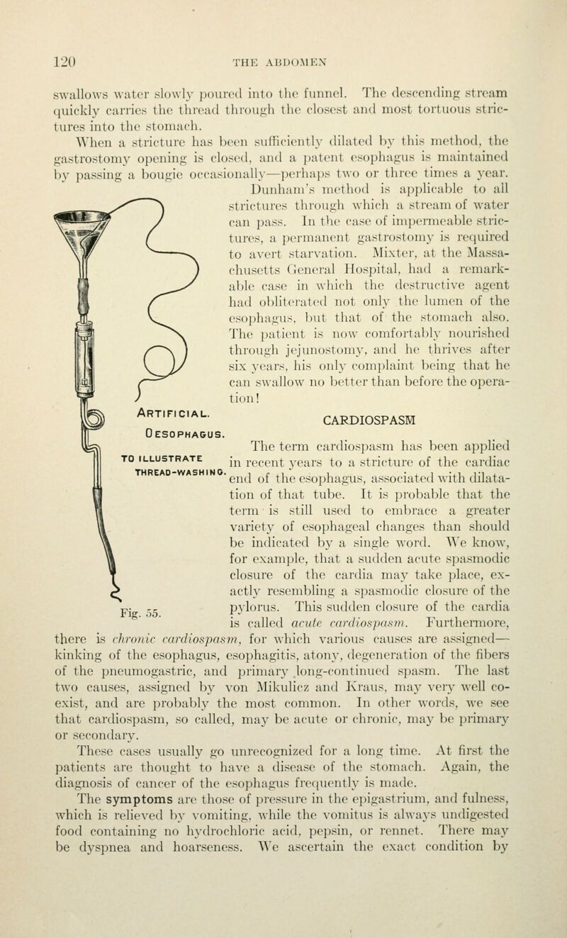 swallows wiiter slowly poured into the fuiin(>l. The descending stream quickly carries the thread tlu()Ui;h the closest and most tortuous stric- tures into the stomach. When a stricture has been sufficiently dilated by this method, the gastrostomy opening is closed, and a patent esophagus is maintained by passing a bougie occasionally—perhaps two or three times a year. Dunham's method is applical)le to all strictures through which a stream of water can pass. In the case of impermeable stric- tures, a permanent gastrostomy is required to avert starvation. Mixter, at the Massa- chusetts General Hospital, had a remark- able case in which the destructive agent had obliterated not only the lumen of the esophagus, but that of the stomach also. The patient is now comfortably nourished through jejunostomy, and he thrives after six years, his only complaint being that he can swallow no better than before the opera- tion! Artificial. Oesophagus. CARDIOSPASM TO ILLUSTRATE THREAD-WASHING. Fig. 55. The term cardiospasm has been applied in recent years to a stricture of the cardiac end of the esophagus, associated with dilata- tion of that tube. It is probable that the term ■ is still used to embrace a greater variety of esophageal changes than should be indicated by a single word. We know, for example, that a sudden acute spasmodic closure of the cardia may take place, ex- actly resembling a spasmodic closure of the P3'lorus. This sudden closure of the cardia is called acute cardiospasm. Furthermore, there is chronic cardiospasm, for which various causes are assigned— kinking of the esophagus, esophagitis, atony, degeneration of the fibers of the pneumogastric, and primary long-continued spasm. The last two causes, assigned by von jMikulicz and Kraus, may very well co- exist, and are probably the most common. In other words, we see that cardiospasm, so called, may be acute or chronic, may be j^rimary or secondary. These cases usually go unrecognized for a long time. At first the patients are thought to have a disease of the stomach. Again, the diagnosis of cancer of the esophagus freciuenth' is made. The symptoms are those of pressure in the epigastrium, and fulness, which is relieved by vomiting, while the vomitus is always undigested food containing no hydrochloric acid, pepsin, or rennet. There may be dyspnea and hoarseness. We ascertain the exact condition by