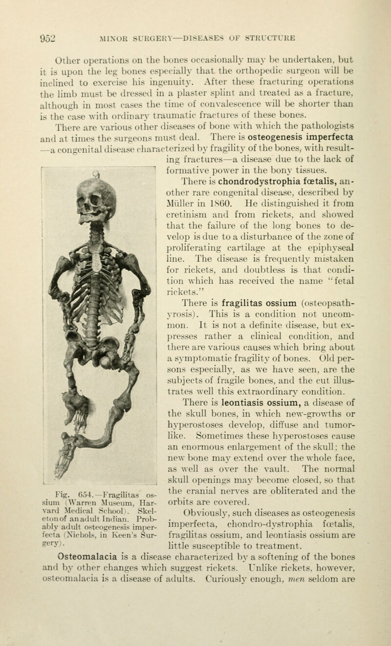 Other operations on the bones occasionally may be undertaken, but it is upon the leg bones especially that the orthopedic surgeon will be inclined to exercise his ingenuity. After these fracturing operations the limb must be dressed in a plaster splint and treated as a fracture, although in most cases the time of convalescence will be shorter than is the case with ordinary traumatic fractures of these bones. There are various other diseases of bone with which the pathologists and at times the surgeons must deal. There is osteogenesis imperfecta —a congenital disease characterized by fragility of the bones, with result- ing fractures—a disease due to the lack of formative power in the bony tissues. There is chondrodystrophia foe talis, an- other rare congenital disease, described by Miiller in ISGO. He tlistingiiished it from cretinism and from rickets, and showed that the failure of the long bones to de- velop is due to a disturbance of the zone of proliferating cartilage at the epiphyseal line. The disease is frec^uently mistaken for rickets, and doubtless is that condi- tion which has received the name ''fetal rickets. There is fragilitas ossium (osteopsath- yrosis). This is a condition not uncom- mon. It is not a definite disease, but ex- presses rather a clinical condition, and there are various causes which bring about a s}-mptomatic fragility of bones. Old per- sons especial!}^, as we have seen, are the subjects of fragile bones, and the cut illus- trates well this extraordinary' condition. There is leontiasis ossium, a disease of the skull bones, in which new-grovrths or hyperostoses develop, diffuse and tumor- like. Sometimes these hyperostoses cause an enormous enlargement of the skull: the new bone may extend over the whole face, as well as over the vault. The normal skull openings may become closed, so that the cranial nerves are obliterated and the orbits are covered. Obviousl}-, such diseases as osteogenesis imperfecta, chondro-dystrophia fetalis. fragilitas ossium, and leontiasis ossium are little susceptible to treatment. Osteomalacia is a disease characterized by a softening of the bones and by other changes which suggest rickets. Unlike rickets, however, osteomalacia is a disease of adults. Curiously enough, 77)en seldom are Fig. 654.—Fragilitas os- sium (Warren Museum, Har- vard Medical School i. Skel- eton of an adult Indian. Prob- ably adult osteogenesis imper- fecta (Nichols, in Keen's Sur- gery).