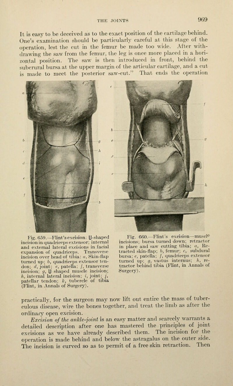 9G9 It is easy to be deceived as to the exact position of the cartilage behind. One's examination should be particularly careful at this stage of the operation, lest the cut in the femur be made too wide. After with- drawing the saw from the femur, the leg is once more placed in a hori- zontal position. The saw is then introduced in front, behind the subcrural bursa at the upper margin of the articular cartilage, and a cut is made to meet the posterior saw-cut. That ends the operation Fig. 659.—Flint's excision: U-shaped incision in quadriceps extensor; internal and external lateral excisions in facial expansion of quadriceps. Transverse incision over head of tibia: a, Skin-flap turned up; b, quadriceps extensor ten- don; d, joint; e, patella; /, transverse incision; g, U shaped muscle incision; h, internal lateral incision; i, joint; /, patellar tendon; A, tubercle of tibia (Flint, in Annals of Surgery). Fig. 660.—Flint's excision—muscie^ incisions; bursa turned down; retractor in place and saw cutting tibia; a, Re- tracted skin-flap; b, femur; c, subdural bursa; e, patella; /, quadriceps extensor turned up; g, vastus internus; h, re- tractor belund tibia (Flint, in Annals of Surgery). practically, for the surgeon may now lift out entire the mass of tuber- culous disease, wire the bones together, and treat the limb as after the ordinary open excision. Excision of the ankle-joint is an easy matter and scarcely warrants a detailed description after one has mastered the principles of joint excisions as we have already described them. The incision for the operation is made behind and below the astragalus on the outer side. The incision is curved so as to permit of a free skin retraction. Then