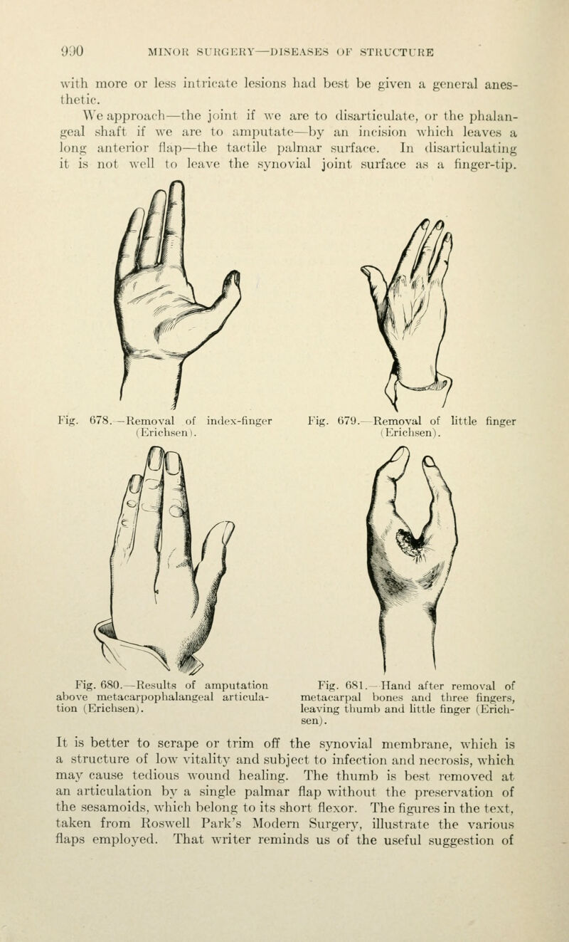 9d0 MIXUlt SUl{Cii:UY—DISEASES (JF STllUCTURE with more or less intricate lesions had best be given a general anes- thetic. We approach—the joint if we are to disai-ticulate, or the phalan- geal shaft if we are to amputate—by an incision which leaves a long anterior flap—the tactile palmar surface. In disarticulating it is not well to leave the synovial joint surface as a finger-tip. Fig. 678. —Removal of index-finger (Erichsen i. Fig. 679.—Removal of little finger (Erichsen). Fig. 680.—Results of amputation Fig. 681. -Hand after removal of above metacarpophalangeal articula- metacarpal bones and three fingers, tion (Erichsen). leaving thumb and Uttle finger (Erich- senj. It is better to scrape or trim off the synovial membrane, which is a structure of low vitality and subject to infection and necrosis, which may cause tedious wound healing. The thumb is best removed at an articulation by a single palmar flap without the preservation of the sesamoids, which belong to its short flexor. The figures in the text, taken from Roswell Park's Modern Surgery, illustrate the various flaps employed. That writer reminds us of the useful suggestion of