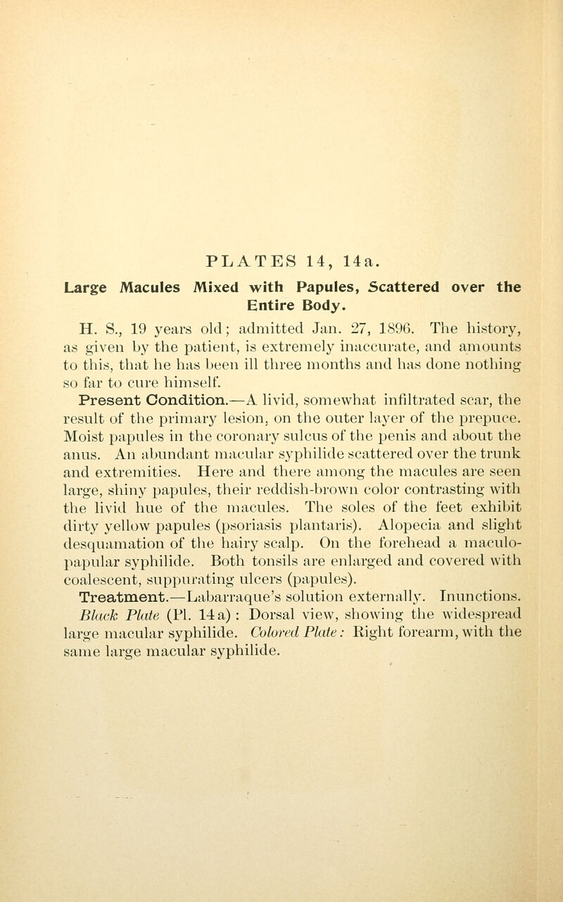 PLATES 14, 14a. Large Macules Mixed with Papules, Scattered over the Entire Body. H. S., 19 years old; admitted Jan. 27, 1896. The history, as given by the patient, is extremely inaccurate, and amounts to this, that he has been ill three months and has done nothing so far to cure himself. Present Condition.—A livid, somewhat infiltrated scar, the result of the primary lesion, on the outer layer of the prepuce. Moist papules in the coronary sulcus of the penis and about the anus. An abundant macular Syphilide scattered over the trunk and extremities. Here and there among the macules are seen large, shiny papules, their reddish-brown color contrasting with the livid hue of the macules. The soles of the feet exhibit dirty yellow papules (psoriasis plantaris). Alopecia and slight desquamation of the hairy scalp. On the forehead a maculo- papular Syphilide. Both tonsils are enlarged and covered with coalescent, suppurating ulcers (papules). Treatment.—Labarraque's solution externally. Inunctions. Black Plate (PI. 14 a) : Dorsal view, showing the widespread large macular Syphilide. Colored Plate: Right forearm, with the same large macular Syphilide.