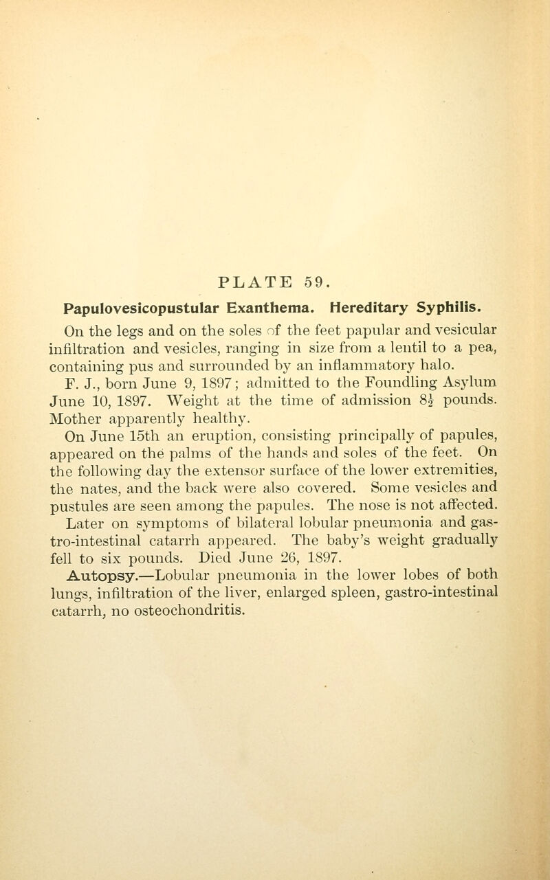 Papulovesicopustular Exanthema. Hereditary Syphilis. On the legs and on the soles of the feet papular and vesicular infiltration and vesicles, ranging in size from a lentil to a pea, containing pus and surrounded by an inflammatory halo. F. J., born June 9, 1897; admitted to the Foundhng Asylum June 10, 1897. Weight at the time of admission 8J pounds. Mother apparently healthy. On June 15th an eruption, consisting principally of papules, appeared on the palms of the hands and soles of the feet. On the following day the extensor surface of the lower extremities, the nates, and the back were also covered. Some vesicles and pustules are seen among the papules. The nose is not affected. Later on symptoms of bilateral lobular pneumonia and gas- tro-intestinal catarrh appeared. The baby's weight gradually fell to six pounds. Died June 26, 1897. Autopsy.—Lobular pneumonia in the lower lobes of both lungs, infiltration of the liver, enlarged spleen, gastro-intestinal catarrh, no osteochondritis.