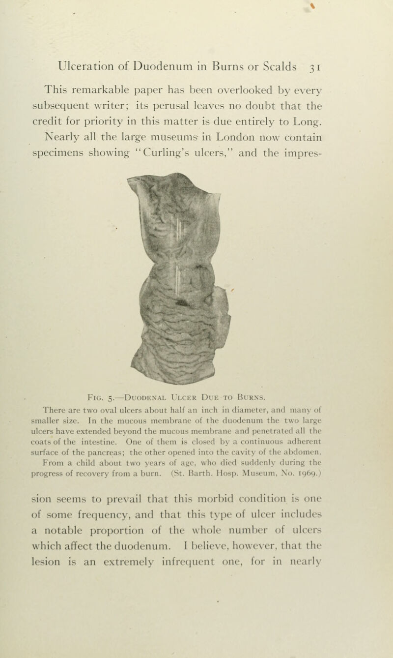 This remarkable paper has been overlooked by every subsequent writer; its perusal leaves no doubt that the credit for priority in this matter is due entirely to Long. Nearly all the large museums in London now contain specimens showing Curling's ulcers, and the impres- Fig. 5.—Duodenal Ulcer Due ro Burns. There are two oval ulcers about half an inch in diameter, and main of smaller size. In the- mucous membrane oi the duodenum the two large ulcers have extended beyond the mucous membrane and penetrated all the coatsofthc intestine. One of thorn i- closed by a continuous adherenl surface of the pancreas; the other opened into the cavity of the abdomen. From a child aboul two years of age, who died suddenly during the progress of recovery from a burn. (St. Barth. Il<»|>. Museum, No. [91 sion seems to prevail thai this morbid condition is one o\ some frequency, and that this type ol ulcer includes a notable proportion of the whole number ot ulcers which affect the duodenum. 1 believe, however, thai the lesion is an extremely infrequenl one, for in nearly