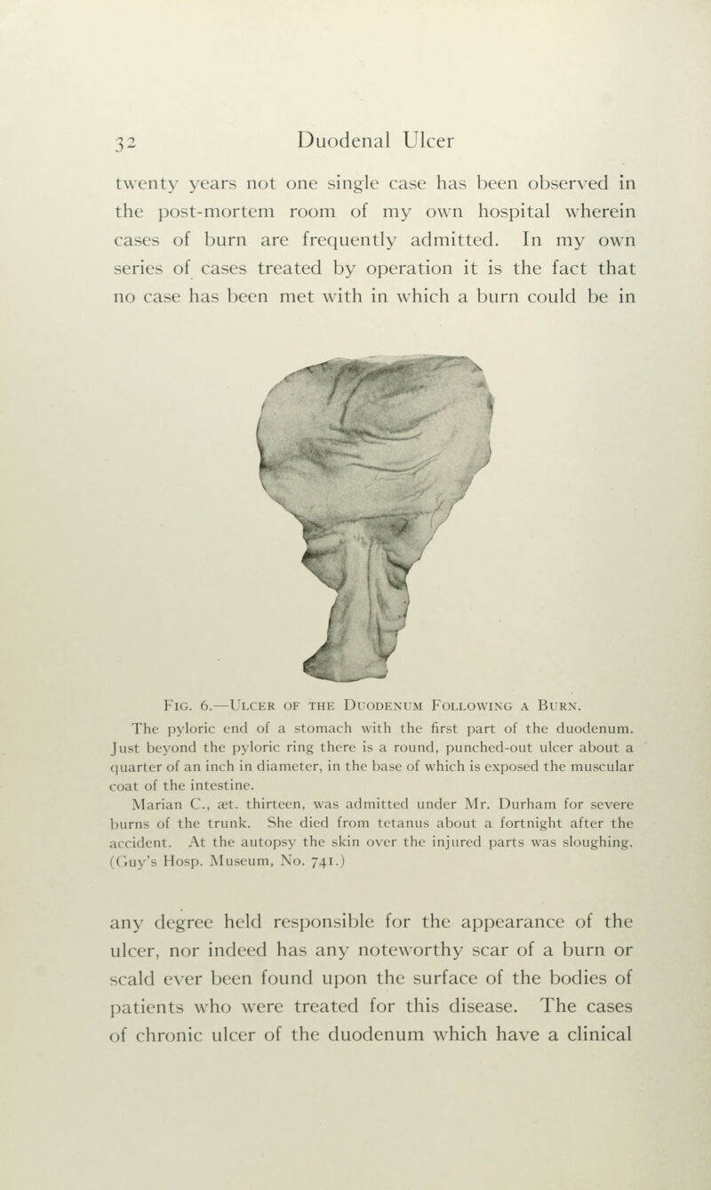 twenty years not one single case has been observed in the post-mortem room of my own hospital wherein cases of burn are frequently admitted. In my own scries of cases treated by operation it is the fact that no case has been met with in which a burn could be in Fig. 6.—Ulcer of the Duodenum Following a Burn. The pyloric end of a stomach with the first part of the duodenum. Just beyond the pyloric ring there is a round, punched-out ulcer about a quarter of an inch in diameter, in the base of which is exposed the muscular coat of the intestine. Marian C, set. thirteen, was admitted under Mr. Durham for severe burns of the trunk. She died from tetanus about a fortnight after the accident. At the autopsy the skin over the injured parts was sloughing. (Guy's Hosp. Museum, No. 741.) any degree held responsible for the appearance of the ulcer, nor indeed has any noteworthy scar of a burn or scald ever been found upon the surface of the bodies of patients who were treated for this disease. The cases of chronic ulcer of the duodenum which have a clinical
