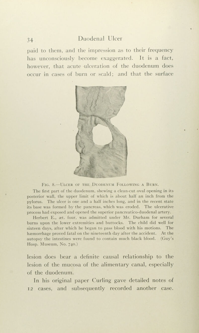 paid to them, and the impression as to their frequency has unconsciously become exaggerated. It is a fact, however, that acute ulceration of the duodenum does occur in cases of burn or scald; and that the surface Fig. 8.—Ulcer of the Duodenum Following a Burn. The first part of the duodenum, shewing a clean-cut oval opening in its posterior wall, the upper limit of which is about half an inch from the pylorus. The ulcer is one and a half inches long, and in the recent state its base was formed by the pancreas, which was eroded. The ulcerative process had exposed and opened the superior pancreatico-duodenal artery. Herbert E., set. four, was admitted under Mr. Durham for several burns upon the lower extremities and buttocks. The child did well for sixteen days, after which he began to pass blood with his motions. The haemorrhage proved fatal on the nineteenth day after the accident. At the autopsy the intestines were found to contain much black blood. (Guy's Hosp. Museum, No. 740.) lesion does bear a definite causal relationship to the lesion of the mucosa of the alimentary canal, especially of the duodenum. In his original paper Curling gave detailed notes of 12 cases, and subsequently recorded another case.