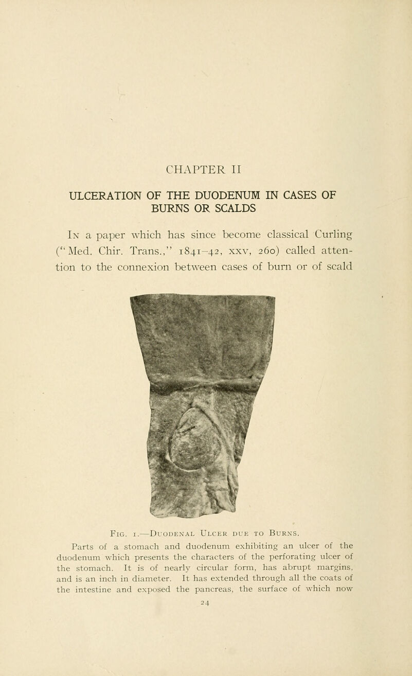 CHAPTER II ULCERATION OF THE DUODENUM IN CASES OF BURNS OR SCALDS In a paper which has since become classical Curling (Med. Chir. Trans., 1841-42, xxv, 260) called atten- tion to the connexion between cases of burn or of scald Fig. i.—Duodenal Ulcer due to Burns. Parts of a stomach and duodenum exhibiting an ulcer of the duodenum which presents the characters of the perforating ulcer of the stomach. It is of nearly circular form, has abrupt margins, and is an inch in diameter. It has extended through all the coats of the intestine and exposed the pancreas, the surface of which now