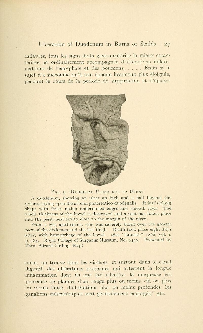 cadavres, tous les signs de la gastro-ent£rite la mieux carac- teris^e, et ordinairement accompagnee d'alterations inflam- matoires de l'enc^phale et des poumons Enfin si le sujet n'a succomb£ qu'a une epoque beaucoup plus eloignee, pendant le cours de la periode de suppuration et d'epuise- Fig. 3.—Duodenal Ulcer due to Burns. A duodenum, showing an ulcer an inch and a half beyond the pylorus laying open the arteria pancreatico-duodenalis. It is of oblong shape with thick, rather undermined edges and smooth floor. The whole thickness of the bowel is destroyed and a rent has taken place into the peritoneal cavity close to the margin of the ulcer. From a girl, aged seven, who was severely burnt over the greater part of the abdomen and the left thigh. Death took place eight days after, with haemorrhage of the bowel. (See Lancet, 1866, vol. i, p. 484. Royal College of Surgeons Museum, No. 2430. Presented by Thos. Blizard Curling, Esq.) ment, on trouve dans les visceres, et surtout dans le canal digestif, des alterations profondes qui attestent la longue inflammation dont ils one ete effectes; la muqueuse est parsemee de plaques d'un rouge plus ou moins \Tif, ou plus ou moins fonce, d'ulcerations plus ou moins profondes; les ganglions mesenteriques sont generalement engorges, etc.