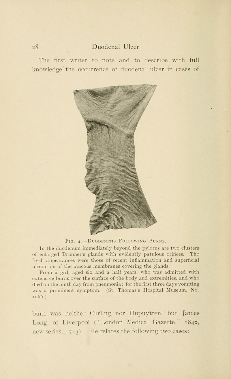 The first writer to note and to describe with full knowledge the occurrence of duodenal ulcer in cases of Fig. 4.—Duodenitis Following Burns. In the duodenum immediately beyond the pylorus are two clusters of enlarged Brunner's glands with evidently patulous orifices. The fresh appearances were those of recent inflammation and superficial ulceration of the mucous membranes covering the glands. From a girl, aged six and a half years, who was admitted with extensive burns over the surface of the body and extremities, and who died on the ninth day from pneumonia; for the first three days vomiting was a prominent symptom. (St. Thomas's Hospital Museum, No. 1066.) burn was neither Curling nor Dupuytren, but James Long, of Liverpool (London Medical Gazette, 1840, new series i, 743). He relates the following two cases: