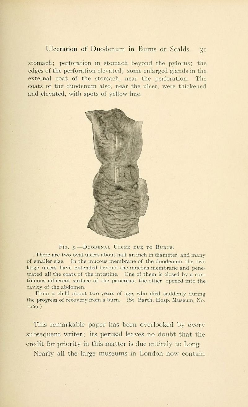 stomach; perforation in stomach beyond the pylorus; the edges of the perforation elevated; some enlarged glands in the external coat of the stomach, near the perforation. The coats of the duodenum also, near the ulcer, were thickened and elevated, with spots of yellow hue. Fig. 5.—Duodenal Ulcer due to Burns. There are two oval ulcers about half an inch in diameter, and many of smaller size. In the mucous membrane of the duodenum the two large ulcers have extended beyond the mucous membrane and pene- trated all the coats of the intestine. One of them is closed by a con- tinuous adherent surface of the pancreas; the other opened into the cavity of the abdomen. From a child about two years of age, who died suddenly during the progress of recovery from a burn. (St. Barth. Hosp. Museum, No. 1969.) This remarkable paper has been overlooked by every subsequent writer; its perusal leaves no doubt that the credit for priority in this matter is due entirely to Long. Nearly all the large museums in London now contain