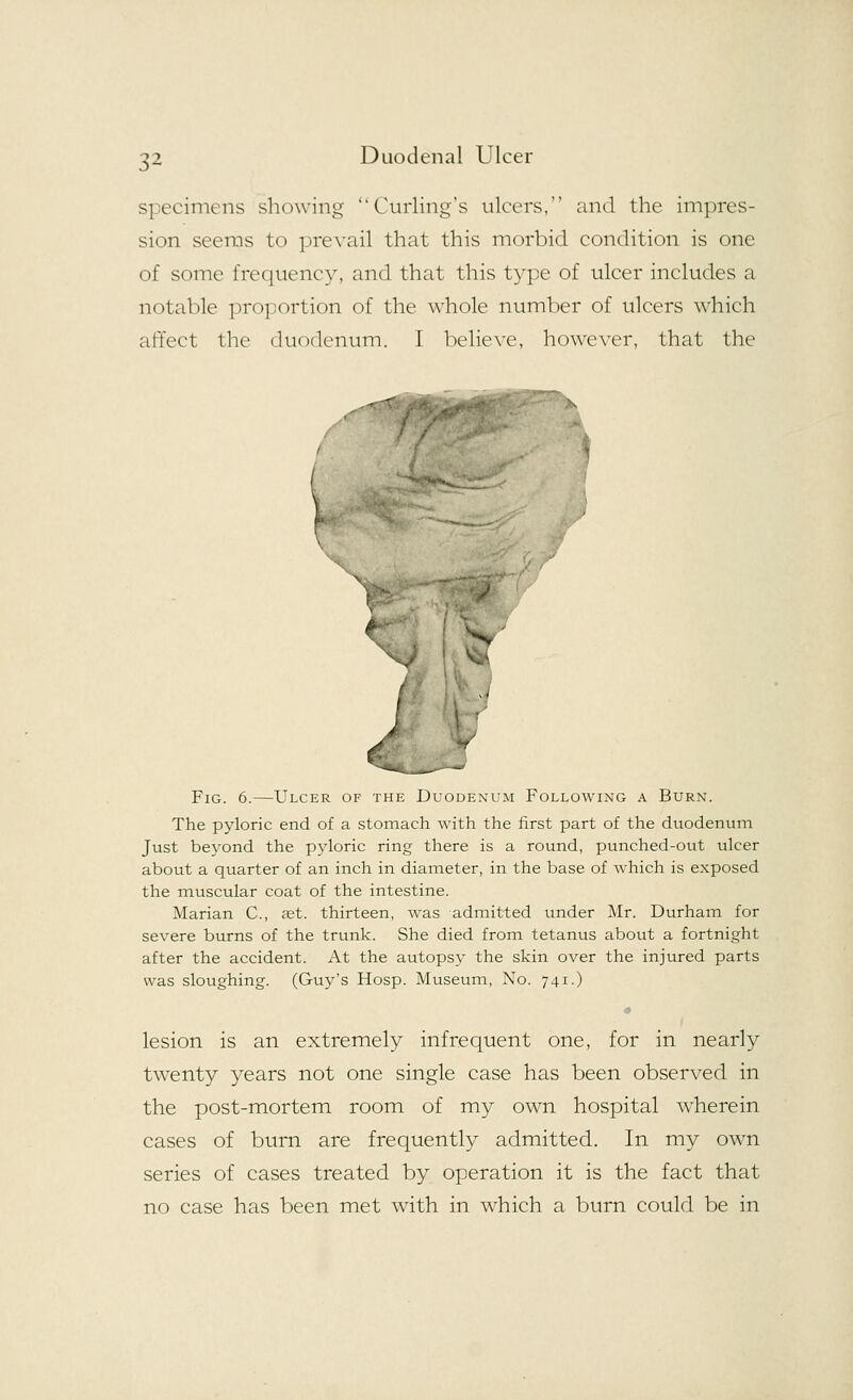 specimens showing Curling's ulcers, and the impres- sion seems to prevail that this morbid condition is one of some frequency, and that this type of ulcer includes a notable proportion of the whole number of ulcers which affect the duodenum. I believe, however, that the v Fig. 6.—Ulcer of the Duodenum Following a Burn. The pyloric end of a stomach with the first part of the duodenum Just beyond the pyloric ring there is a round, punched-out ulcer about a quarter of an inch in diameter, in the base of which is exposed the muscular coat of the intestine. Marian C, aet. thirteen, was admitted ttnder Mr. Durham for severe burns of the trunk. She died from tetanus about a fortnight after the accident. At the autopsy the skin over the injured parts was sloughing. (Guy's Hosp. Museum, No. 741.) lesion is an extremely infrequent one, for in nearly twenty years not one single case has been observed in the post-mortem room of my own hospital wherein cases of burn are frequently admitted. In my own series of cases treated by operation it is the fact that no case has been met with in which a burn could be in