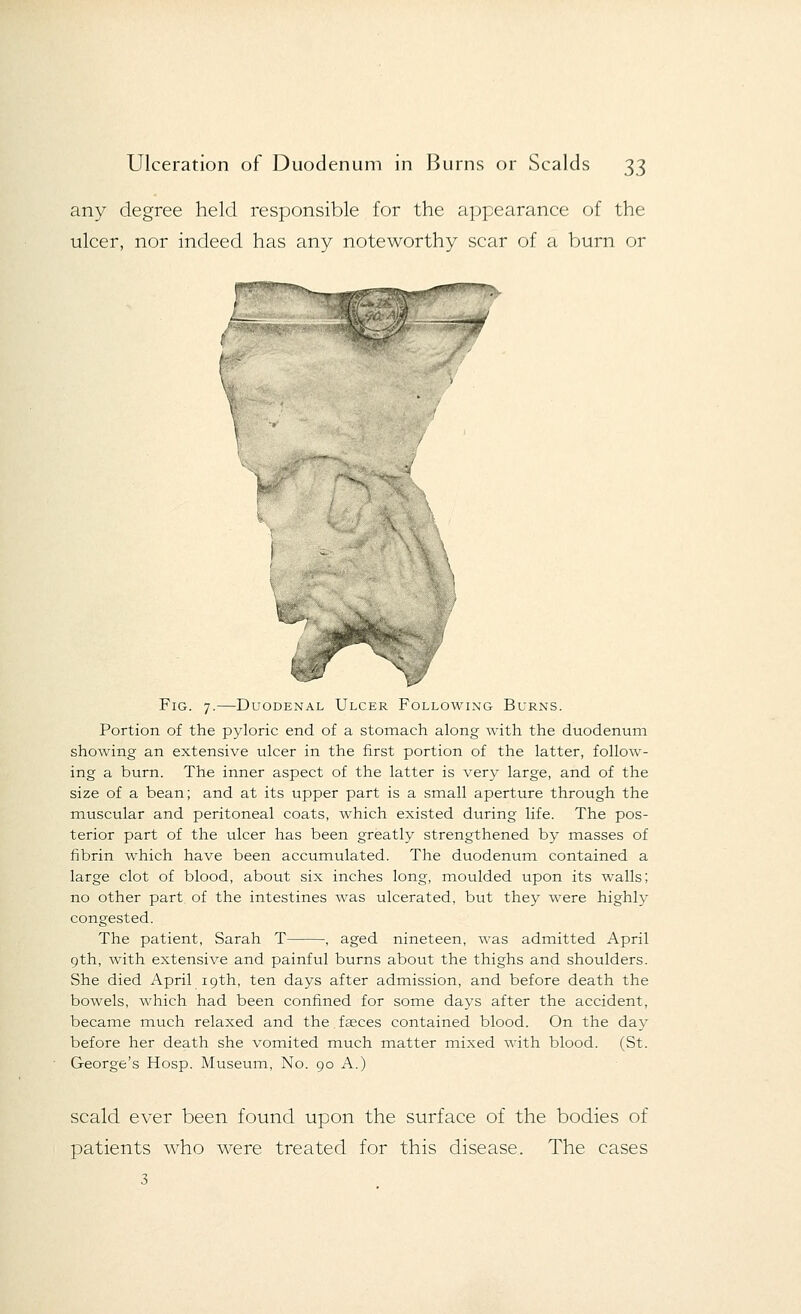 any degree held responsible for the appearance of the ulcer, nor indeed has any noteworthy scar of a burn or I-- Fig. 7.—Duodenal Ulcer Following Burns. Portion of the pyloric end of a stomach along with the duodenum showing an extensive ulcer in the first portion of the latter, follow- ing a burn. The inner aspect of the latter is very large, and of the size of a bean; and at its upper part is a small aperture through the muscular and peritoneal coats, which existed during life. The pos- terior part of the ulcer has been greatly strengthened by masses of fibrin which have been accumulated. The duodenum contained a large clot of blood, about six inches long, moulded upon its walls; no other part of the intestines was ulcerated, but they were highly congested. The patient, Sarah T , aged nineteen, was admitted April 9th, with extensive and painful burns about the thighs and shoulders. She died April 19th, ten days after admission, and before death the bowels, which had been confined for some days after the accident, became much relaxed and the faeces contained blood. On the day before her death she vomited much matter mixed with blood. (St. George's Hosp. Museum, No. 90 A.) scald ever been found upon the surface of the bodies of patients who were treated for this disease. The cases 3