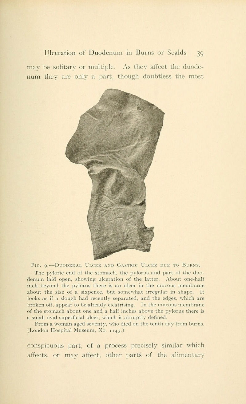 may be solitary or multiple. As they affect the duode- num they are only a part, though doubtless the most Fig. 9.—Duodenal Ulcer and Gastric Ulcer due to Burns. The pyloric end of the stomach, the pylorus and part of the duo- denum laid open, showing ulceration of the latter. About one-half inch bej^ond the pylorus there is an ulcer in the mucous membrane about the size of a sixpence, but somewhat irregular in shape. It looks as if a slough had recently separated, and the edges, which are broken off, appear to be already cicatrising. In the mucous membrane of the stomach about one and a half inches above the pylorus there is a small oval superficial ulcer, which is abruptly defined. From a woman aged seventy, who died on the tenth day from burns. (London Hospital Museum, No. 1143.) conspicuous part, of a process precisely similar which affects, or may affect, other parts of the alimentary