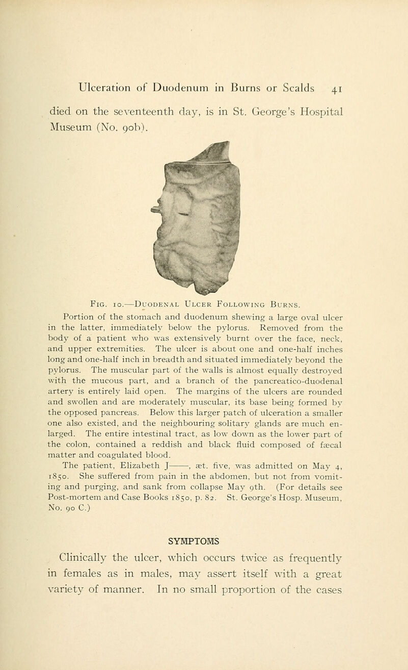 died on the seventeenth day, is in St. George's Hospital Museum (No. 90b). Fig. 10.—Duodenal Ulcer Following Burns. Portion of the stomach and duodenum shewing a large oval ulcer in the latter, immediately below the pylorus. Removed from the body of a patient who was extensively burnt over the face, neck, and upper extremities. The ulcer is about one and one-half inches long and one-half inch in breadth and situated immediately beyond the pylorus. The muscular part of the walls is almost equally destroyed with the mucous part, and a branch of the pancreatico-duodenal artery is entirely laid open. The margins of the ulcers are rounded and swollen and are moderately muscular, its base being formed by the opposed pancreas. Below this larger patch of ulceration a smaller one also existed, and the neighbouring solitary glands are much en- larged. The entire intestinal tract, as low down as the lower part of the colon, contained a reddish and black fluid composed of faecal matter and coagulated blood. The patient, Elizabeth J , aet. five, was admitted on May 4, 1850. She suffered from pain in the abdomen, but not from vomit- ing and purging, and sank from collapse May 9th. (For details see Post-mortem and Case Books 1850, p. 82. St. George's Hosp. Museum, No. 90 C.) SYMPTOMS Clinically the ulcer, which occurs twice as frequently in females as in males, may assert itself with a great variety of manner. In no small proportion of the cases
