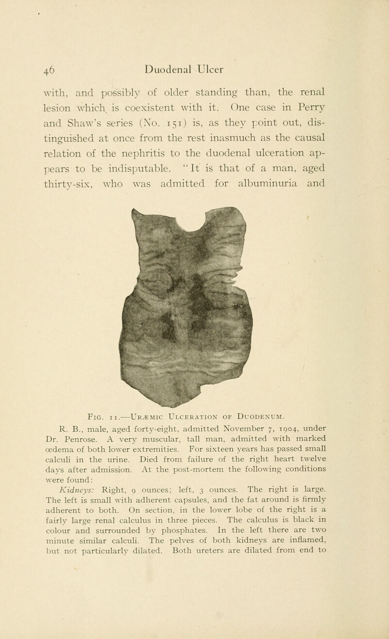 with, and possibly of older standing than, the renal lesion which is coexistent with it. One case in Perry and Shaw's series (No. 151) is, as they point out, dis- tinguished at once from the rest inasmuch as the causal relation of the nephritis to the duodenal ulceration ap- pears to be indisputable. ''It is that of a man, aged thirty-six, who was admitted for albuminuria and Fig. 11.—Uremic Ulceration of Duodenum. R. B., male, aged forty-eight, admitted November 7, 1904, under Dr. Penrose. A very muscular, tall man, admitted with marked cedema of both lower extremities. For sixteen years has passed small calculi in the urine. Died from failure of the right heart twelve days after admission. At the post-mortem the following conditions were found: Kidneys: Right, 9 ounces; left, 3 ounces. The right is large. The left is small with adherent capsules, and the fat around is firmly adherent to both. On section, in the lower lobe of the right is a fairly large renal calculus in three pieces. The calculus is black in colour and surrounded by phosphates. In the left there are two minute similar calculi. The pelves of both kidneys are inflamed, but not particularly dilated. Both ureters are dilated from end to