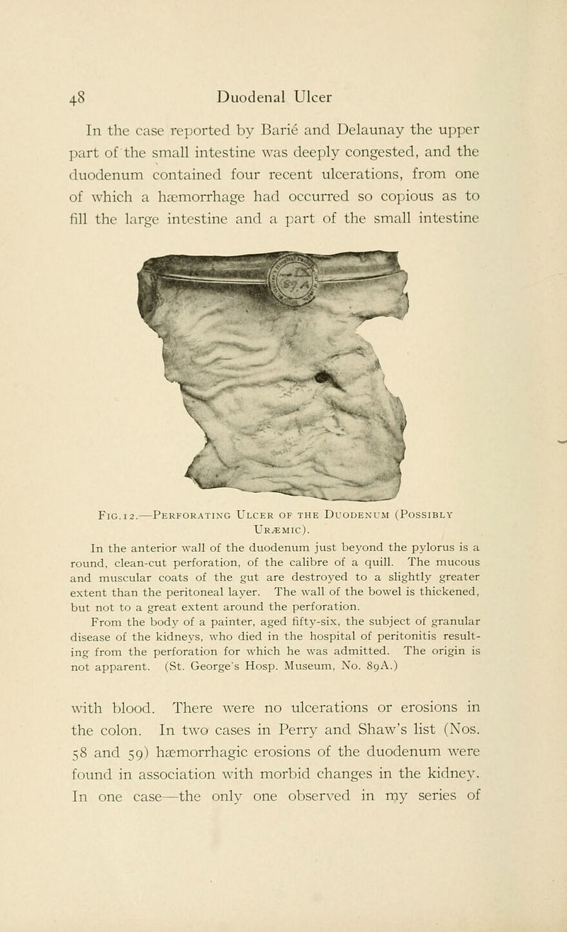 In the case reported by Barie and Delaunay the upper part of the small intestine was deeply congested, and the duodenum contained four recent ulcerations, from one of which a haemorrhage had occurred so copious as to fill the large intestine and a part of the small intestine X \ > Fig.12.—Perforating Ulcer of the Duodenum (Possibly Uremic). In the anterior wall of the duodenum just beyond the pylorus is a round, clean-cut perforation, of the calibre of a quill. The mucous and muscular coats of the gut are destroyed to a slightly greater extent than the peritoneal layer. The wall of the bowel is thickened, but not to a great extent around the perforation. From the body of a painter, aged fifty-six, the subject of granular disease of the kidneys, who died in the hospital of peritonitis result- ing from the perforation for which he was admitted. The origin is not apparent. (St. George's Hosp. Museum, No. 89A.) with blood. There were no ulcerations or erosions in the colon. In two cases in Perry and Shaw's list (Nos. 58 and 59) hemorrhagic erosions of the duodenum were found in association with morbid changes in the kidney. In one case—the only one observed in my series of