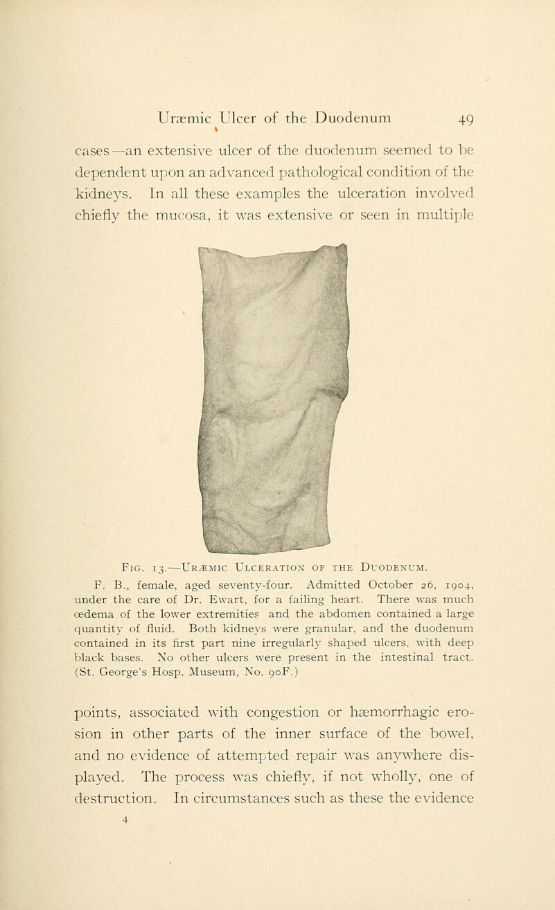 cases—an extensive ulcer of the duodenum seemed to be dependent upon an advanced pathological condition of the kidneys. In all these examples the ulceration involved chiefly the mucosa, it was extensive or seen in multiple r Fig. 13.—Ur.-emic Ulceration of the Duodenum. F. B., female, aged seventy-four. Admitted October 26, 1904, under the care of Dr. Ewart, for a failing heart. There was much cedema of the lower extremities and the abdomen contained a large quantity of fluid. Both kidneys were granular, and the duodenum contained in its first part nine irregularly shaped ulcers, with deep black bases. No other ulcers were present in the intestinal tract. (St. George's Hosp. Museum, No. 90F.) points, associated with congestion or haemorrhagic ero- sion in other parts of the inner surface of the bowel, and no evidence of attempted repair was anywhere dis- played. The process was chiefly, if not wholly, one of destruction. In circumstances such as these the evidence 4