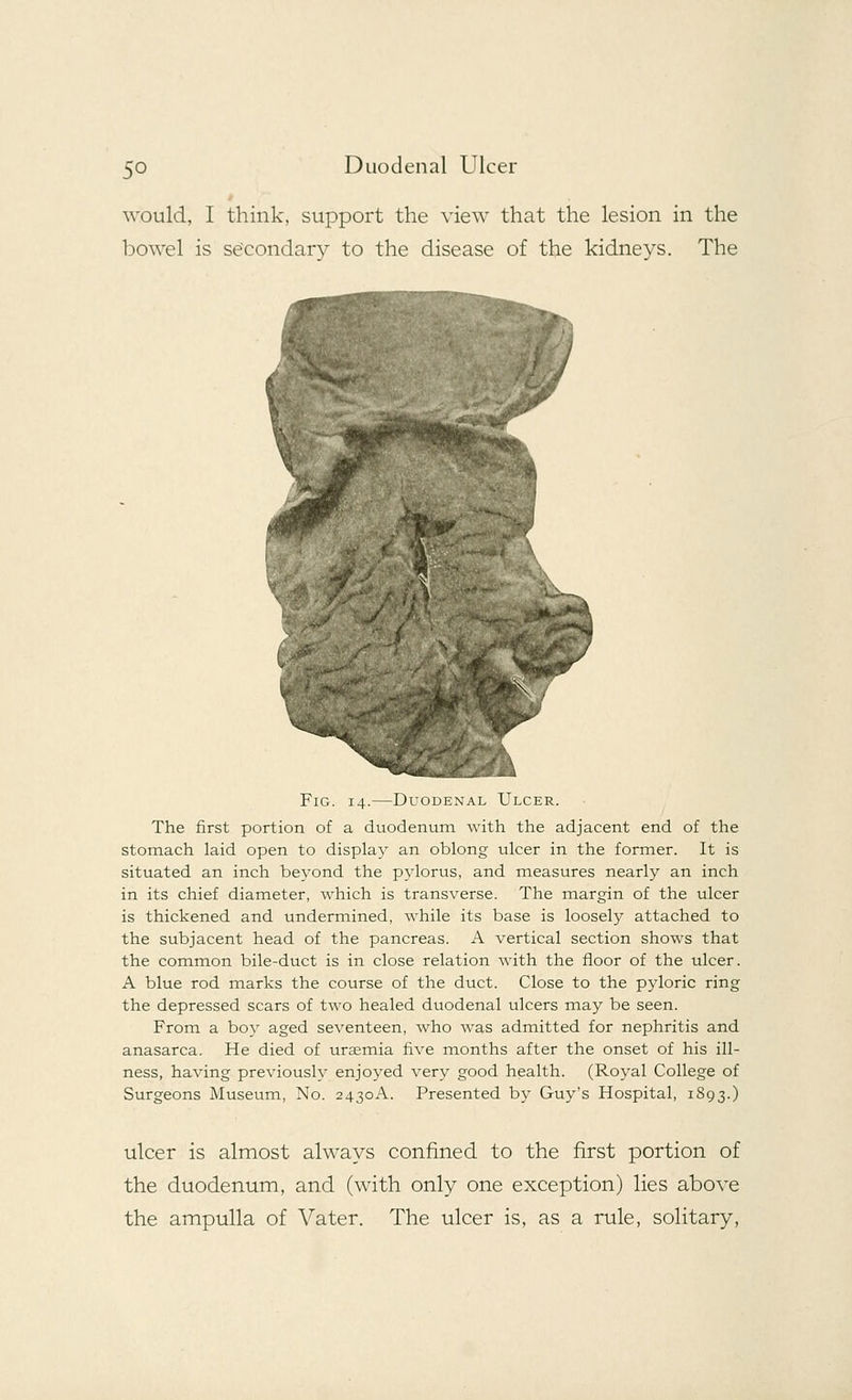 would, I think, support the view that the lesion in the bowel is secondary to the disease of the kidneys. The Fig. 14.—Duodenal Ulcer. The first portion of a duodenum with the adjacent end of the stomach laid open to display an oblong ulcer in the former. It is situated an inch beyond the pylorus, and measures nearly an inch in its chief diameter, which is transverse. The margin of the ulcer is thickened and undermined, while its base is loosely attached to the subjacent head of the pancreas. A vertical section shows that the common bile-duct is in close relation with the floor of the ulcer. A blue rod marks the course of the duct. Close to the pyloric ring the depressed scars of two healed duodenal ulcers may be seen. From a boy aged seventeen, who was admitted for nephritis and anasarca. He died of uraemia five months after the onset of his ill- ness, having previously enjoyed very good health. (Royal College of Surgeons Museum, No. 2430A. Presented by Guy's Hospital, 1893.) ulcer is almost always confined to the first portion of the duodenum, and (with only one exception) lies above the ampulla of Vater. The ulcer is, as a rule, solitary,