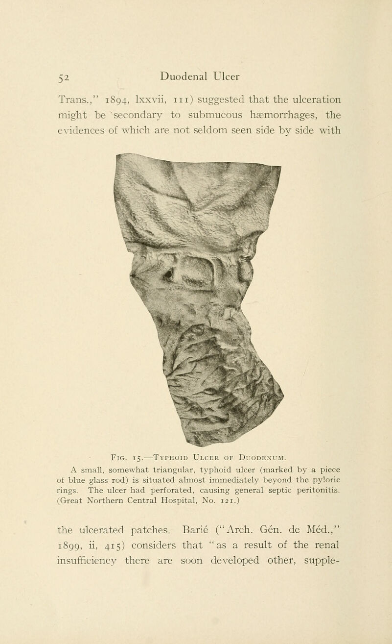 Trans,, 1894, lxxvii, 111) suggested that the ulceration might be secondary to submucous haemorrhages, the evidences of which are not seldom seen side by side with Fig. 15.—Typhoid Ulcer of Duodenum. A small, somewhat triangular, typhoid ulcer (marked by a piece ot blue glass rod) is situated almost immediately beyond the pyloric rings. The ulcer had perforated, causing general septic peritonitis. (Great Northern Central Hospital, No. 121.) the ulcerated patches. Barie (Arch. Gen. de Med., 1899, ii, 415) considers that as a result of the renal insufficiency there are soon developed other, supple-