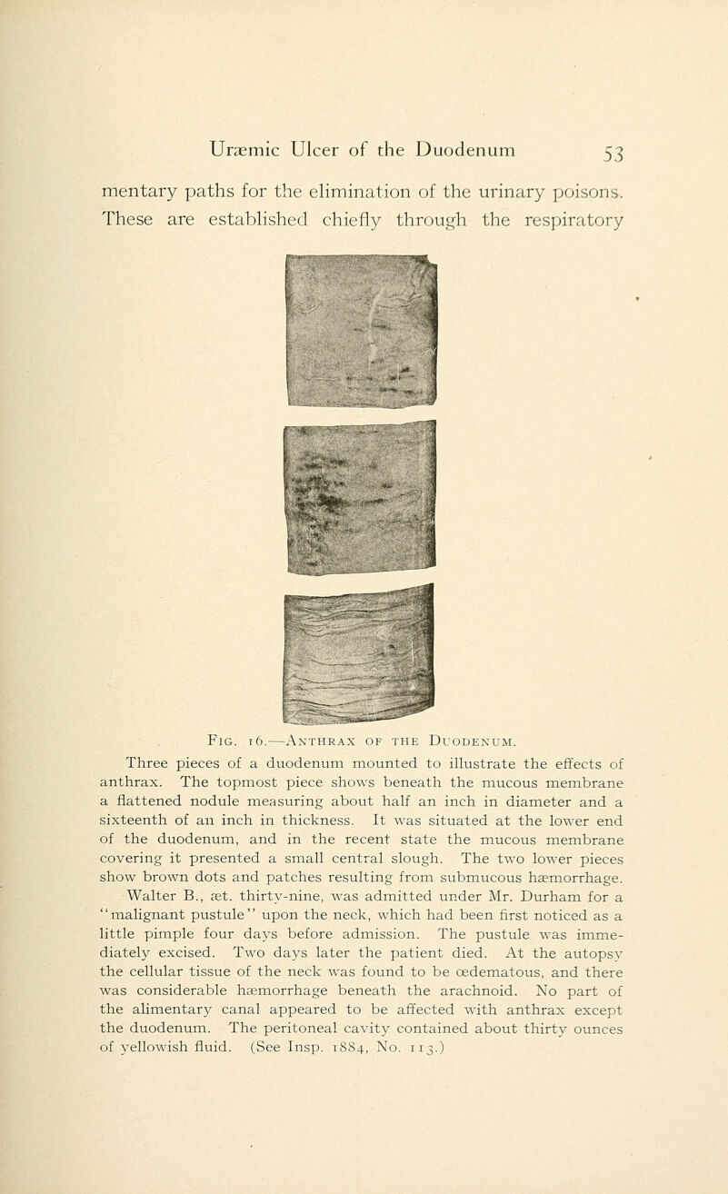 mentary paths for the elimination of the urinary poisons. These are established chiefly through the respiratory Fig. t6.—Anthrax of the Duodenum. Three pieces of a duodenum mounted to illustrate the effects of anthrax. The topmost piece shows beneath the mucous membrane a flattened nodule measuring about half an inch in diameter and a sixteenth of an inch in thickness. It was situated at the lower end of the duodenum, and in the recent state the mucous membrane covering it presented a small central slough. The two lower pieces show brown dots and patches resulting from submucous haemorrhage. Walter B., ast. thirty-nine, was admitted under Mr. Durham for a malignant pustule upon the neck, which had been first noticed as a little pimple four days before admission. The pustule was imme- diately excised. Two days later the patient died. At the autopsv the cellular tissue of the neck was found to be cedematous, and there was considerable haemorrhage beneath the arachnoid. No part of the alimentary canal appeared to be affected with anthrax except the duodenum. The peritoneal cavity contained about thirty ounces of yellowish fluid. (See Insp. 1884, No. 113.)